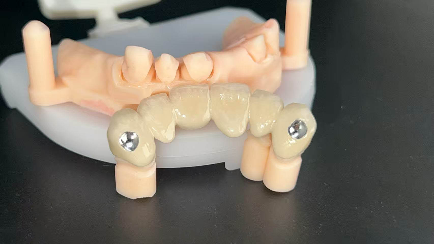Co - Cr PFM Dental Bridge