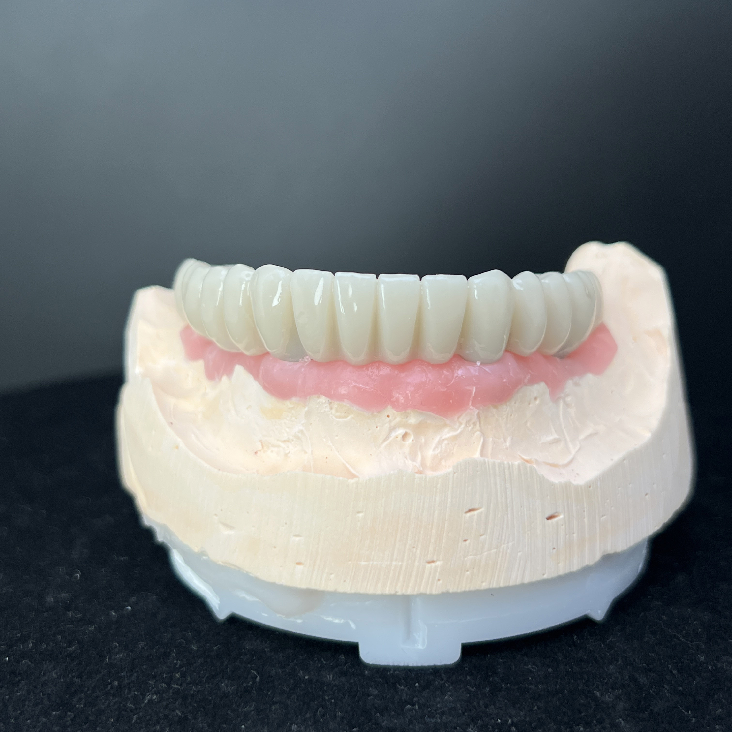 Full arch restoration for temp