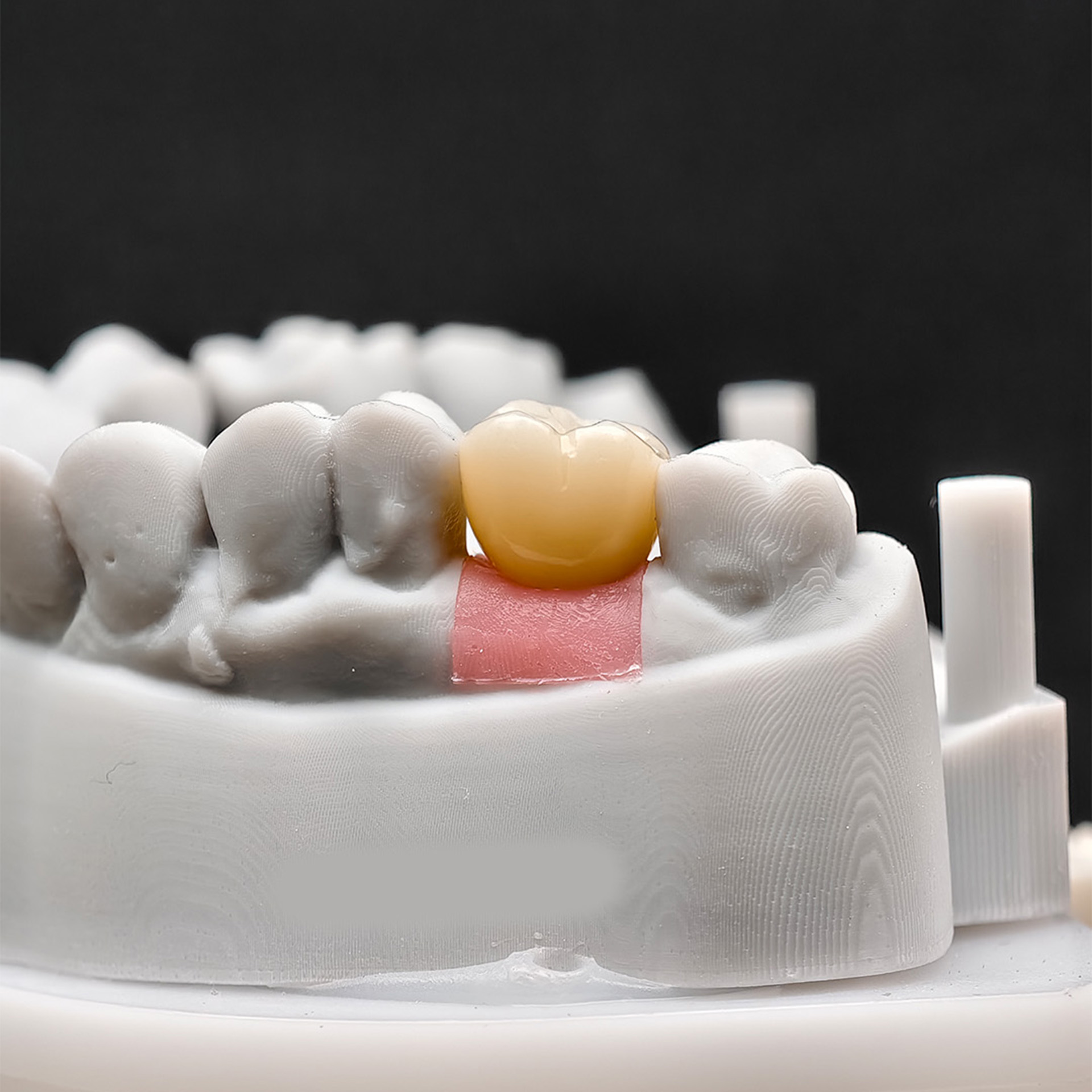 Custom Zirconia Implant Crown