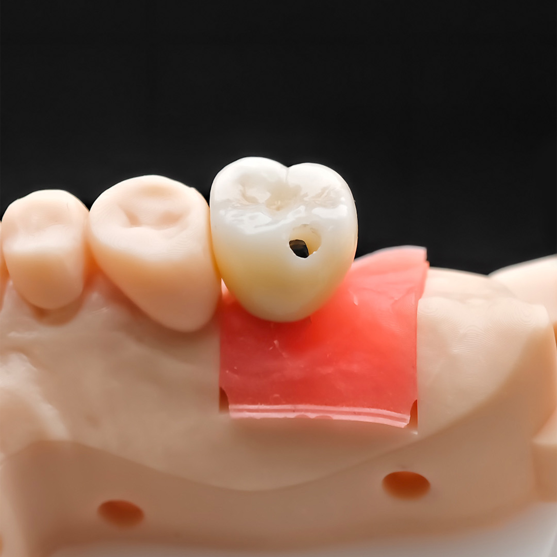 Custom Zirconia Implant Crown