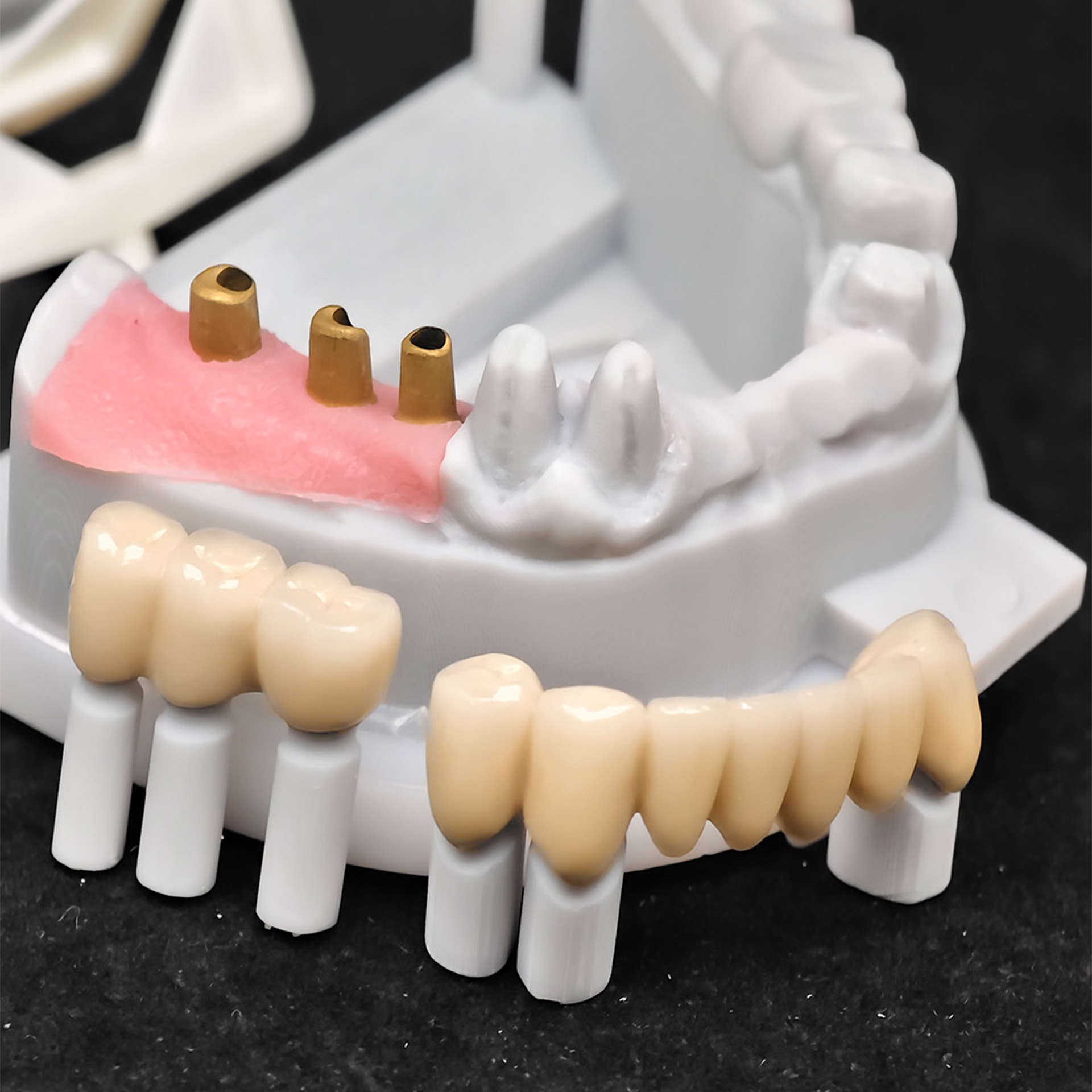 Co - Cr PFM Dental Bridge