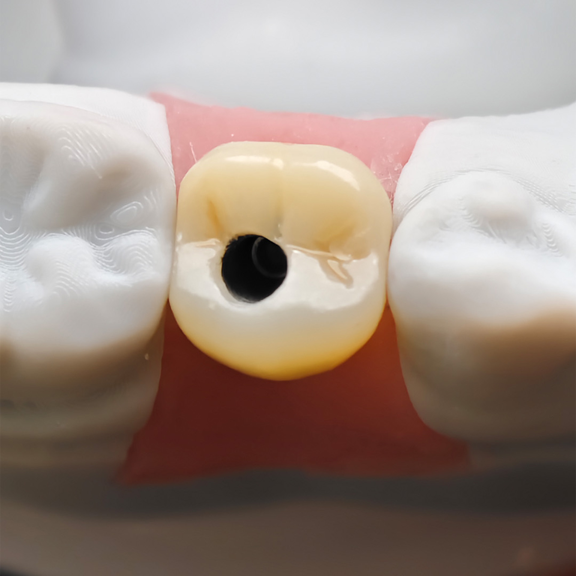 Custom Zirconia Implant Crown