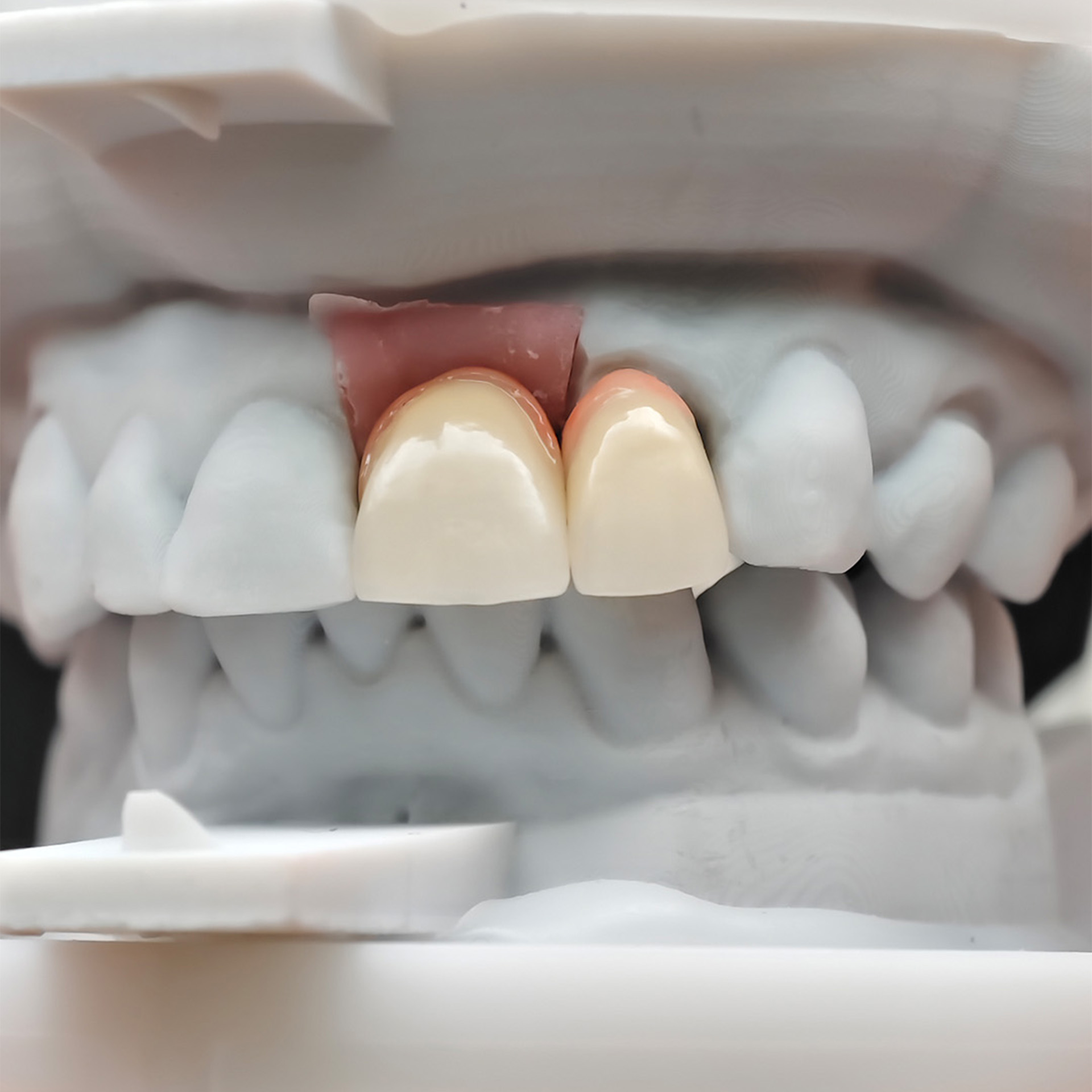 ustom Zirconia Implant Crowns