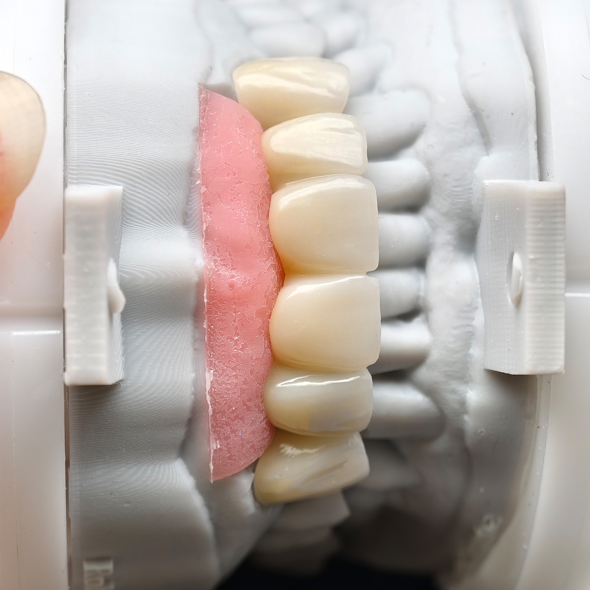Custom Zirconia Implant Bridge