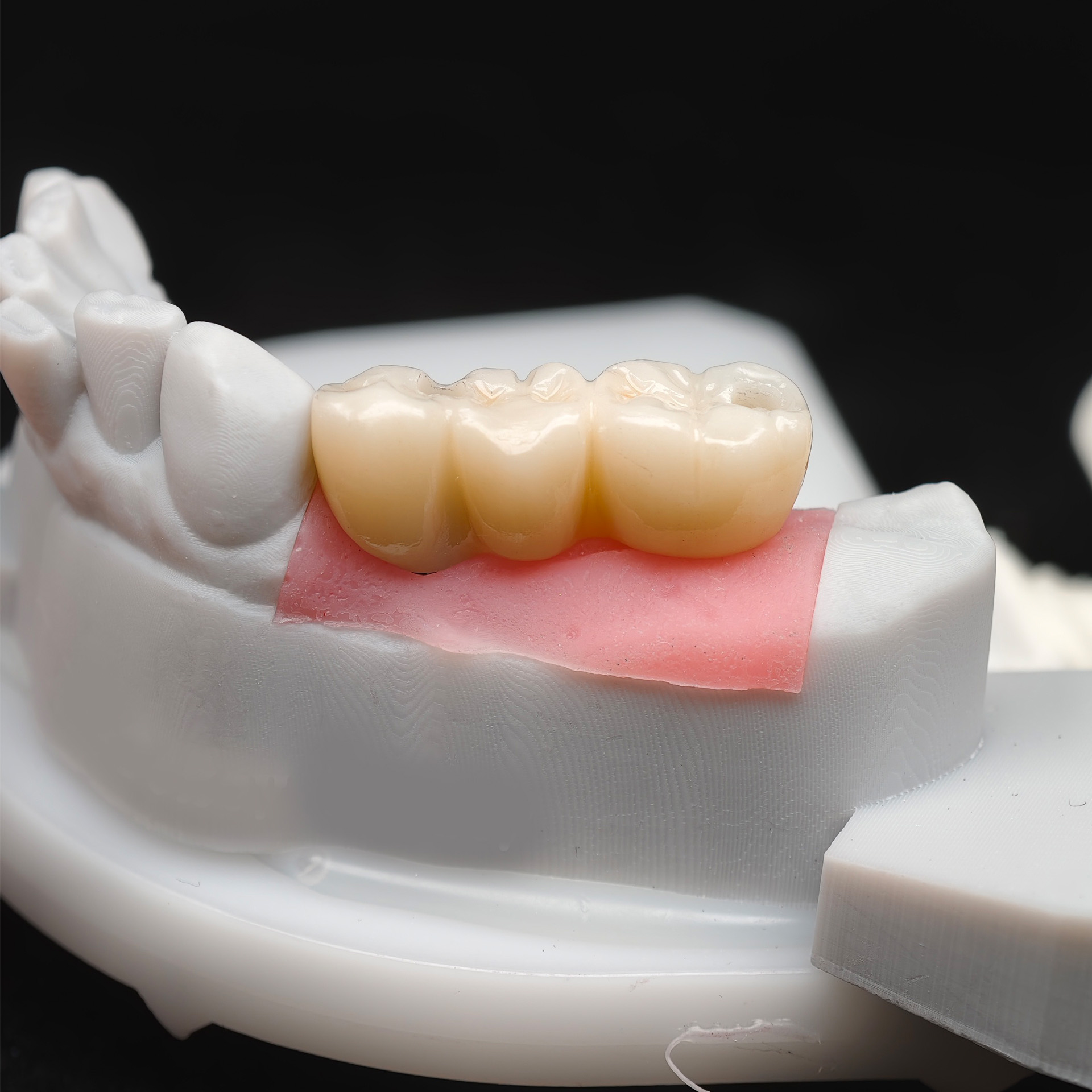Custom Zirconia Implant Bridge