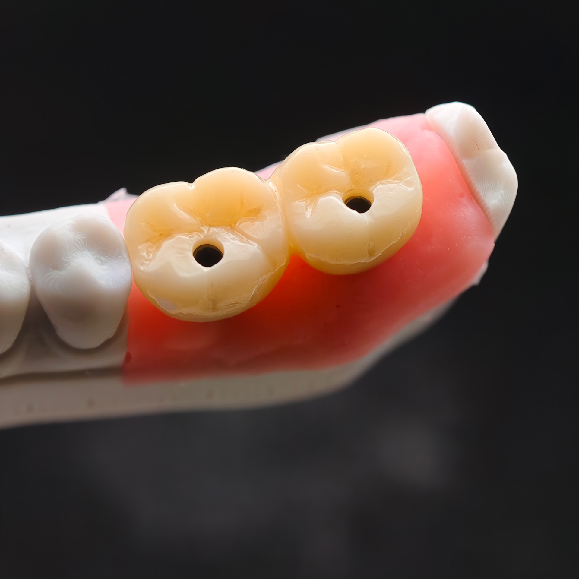 Custom Zirconia Implant Bridge