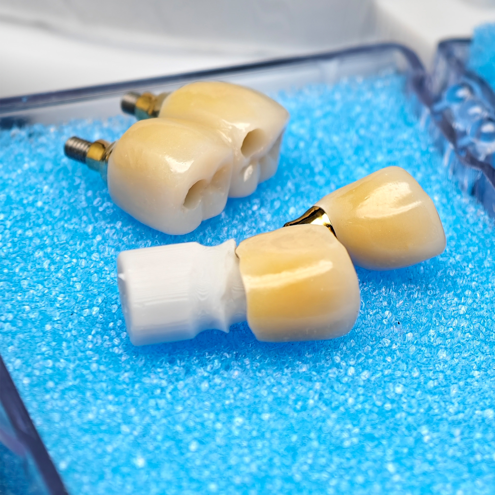 Custom Zirconia Implant Crown and Bridge