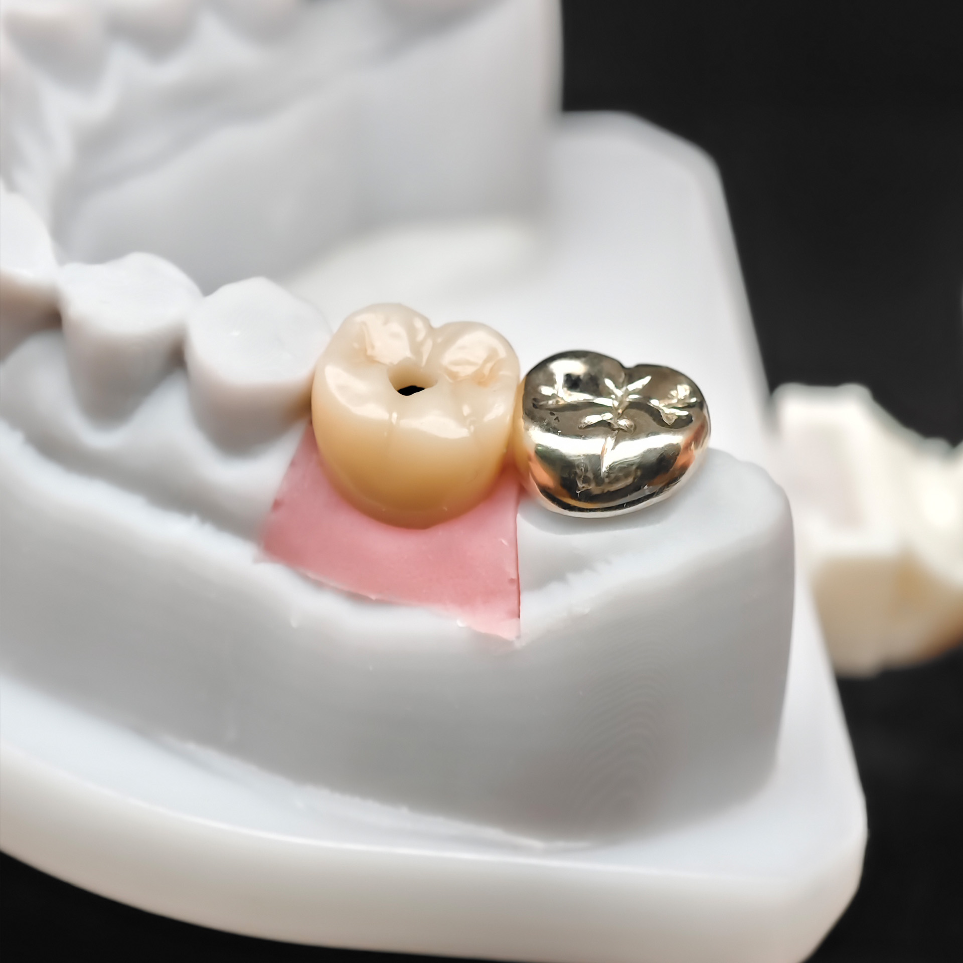 PFM single crowns with metal surface den