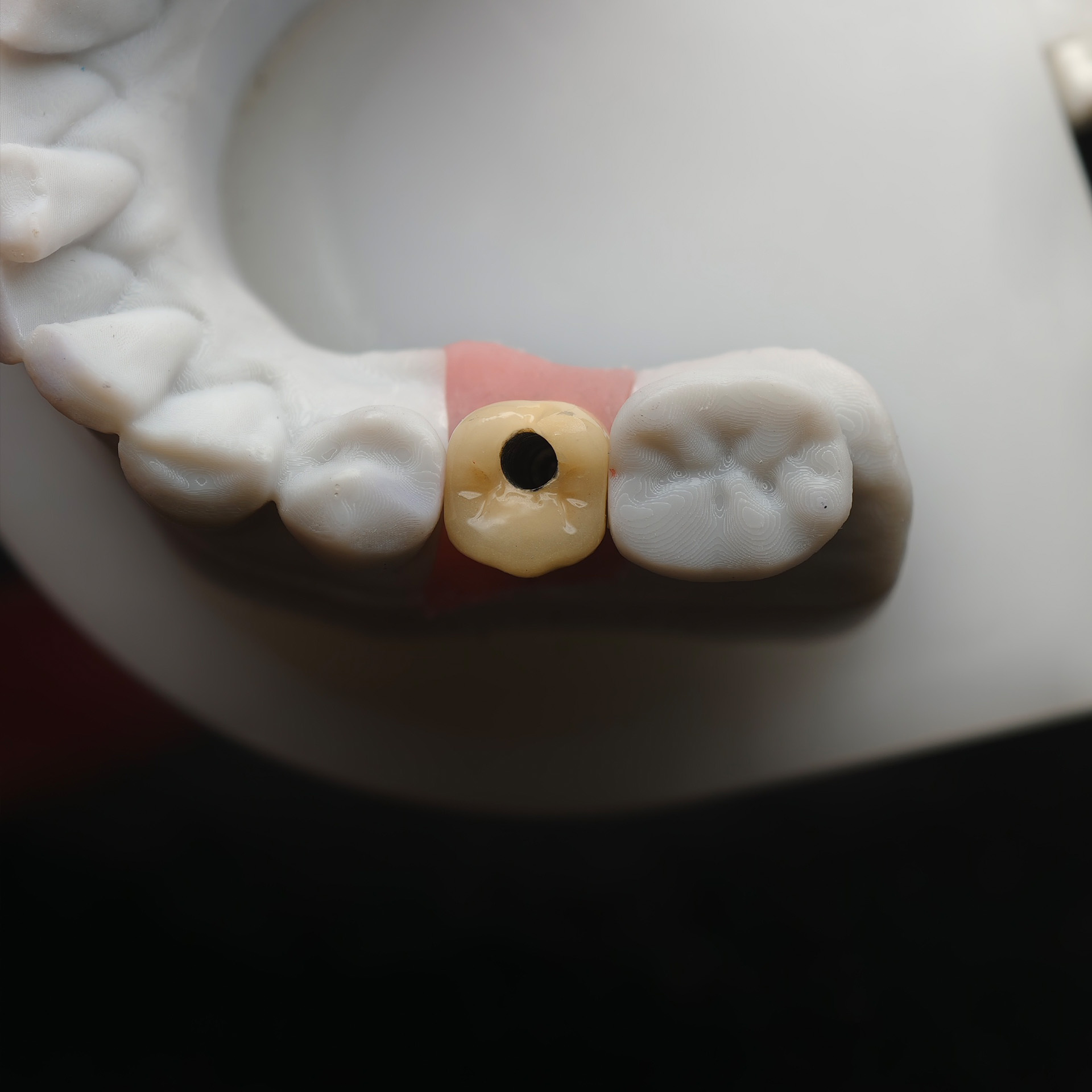 Implant-supported PFM single c