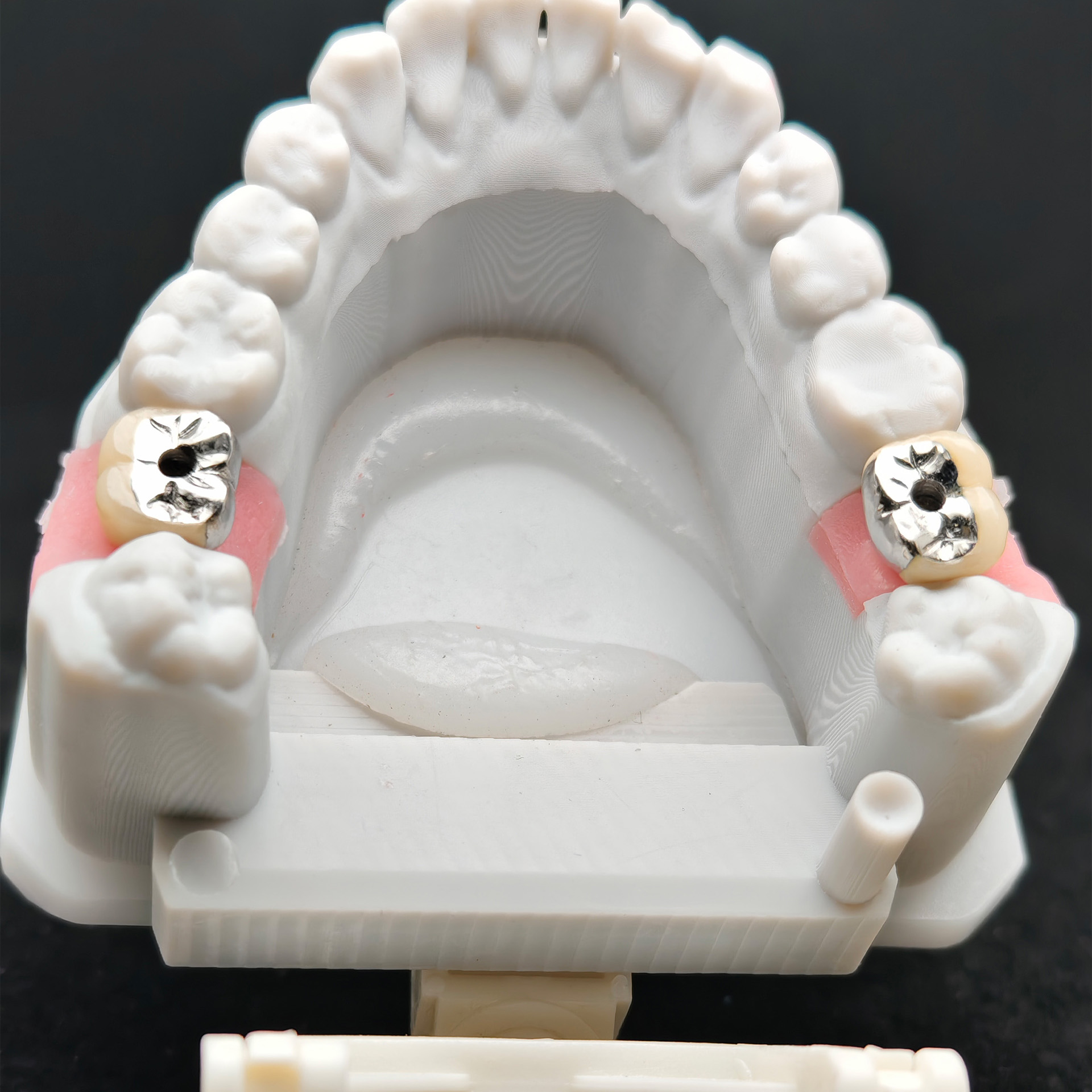 Implant-supported PFM single crown with 