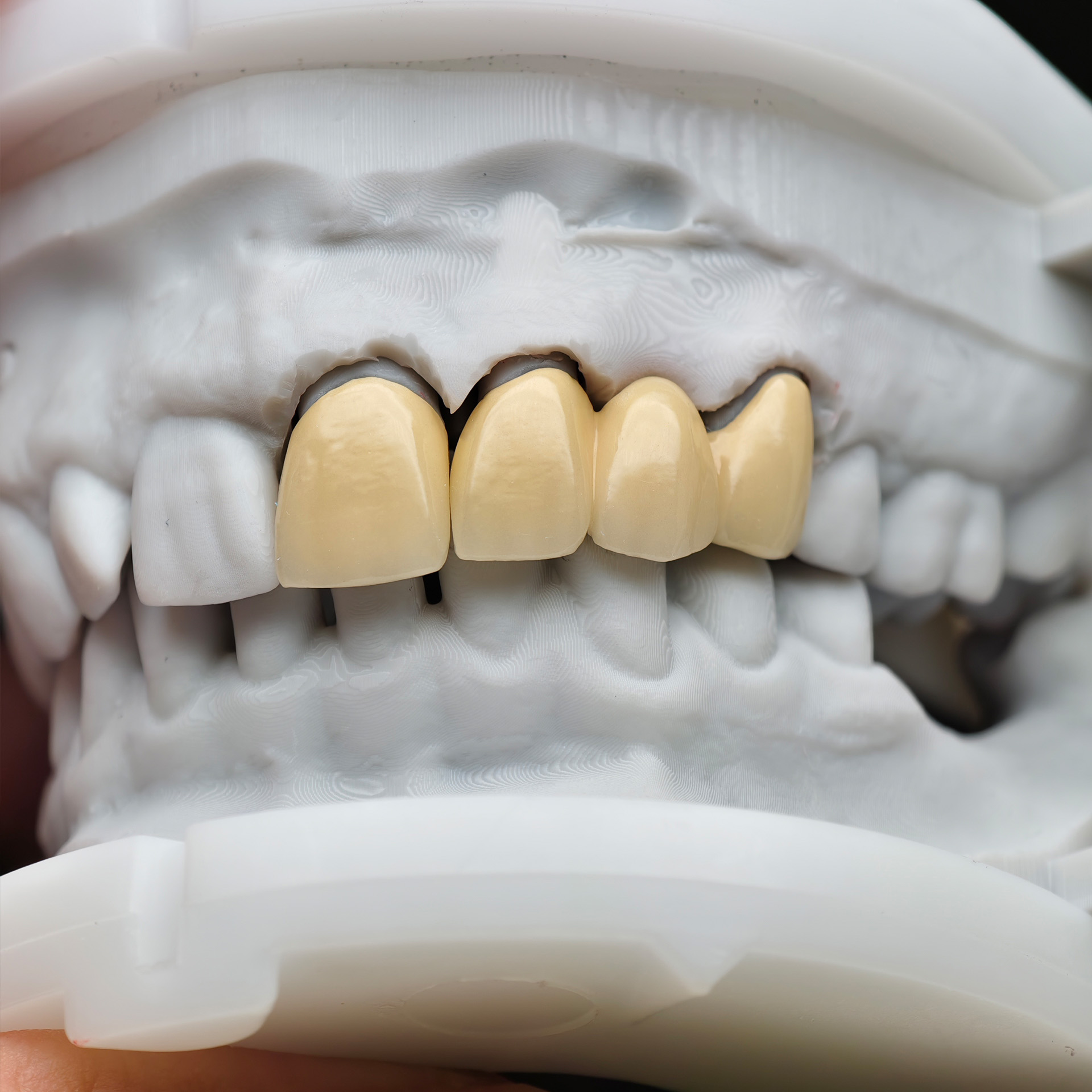 Co - Cr PFM Dental Bridge with Metal Pos