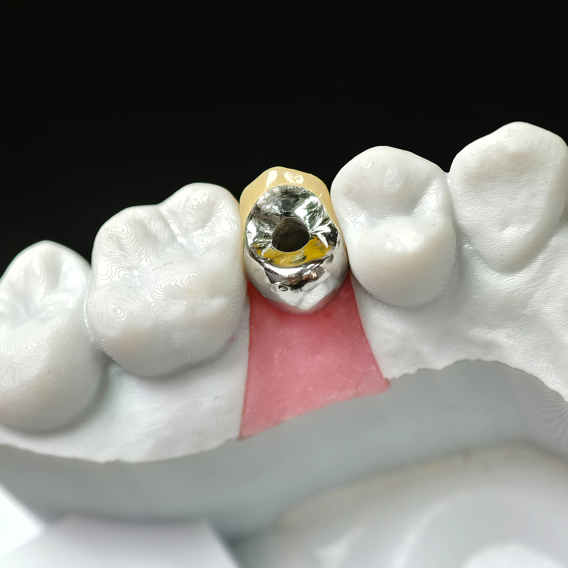 Implant-supported PFM single crown with 