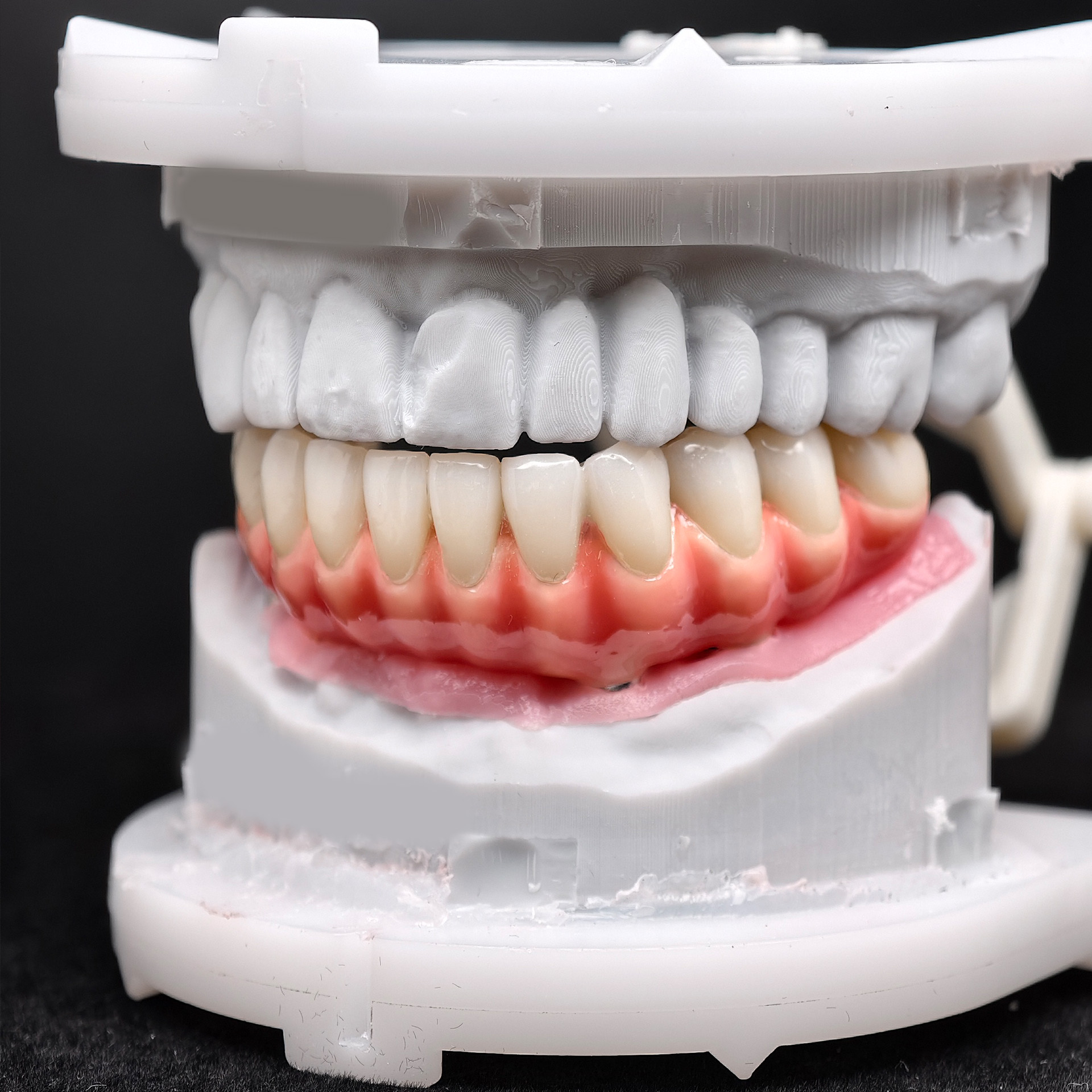 Zirconia-Enamel Hybrid Malo Bridge