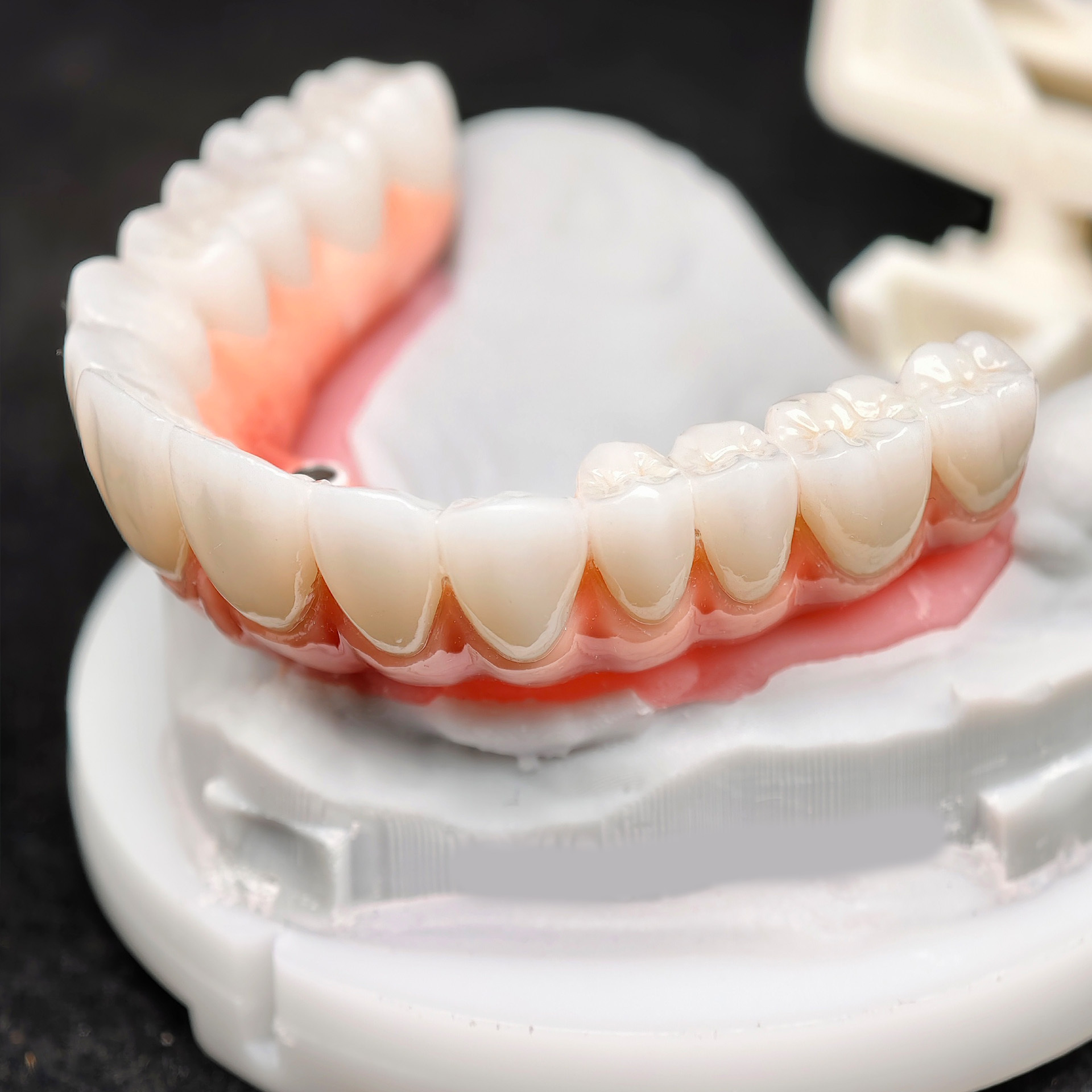 Zirconia-Enamel Hybrid Malo Bridge