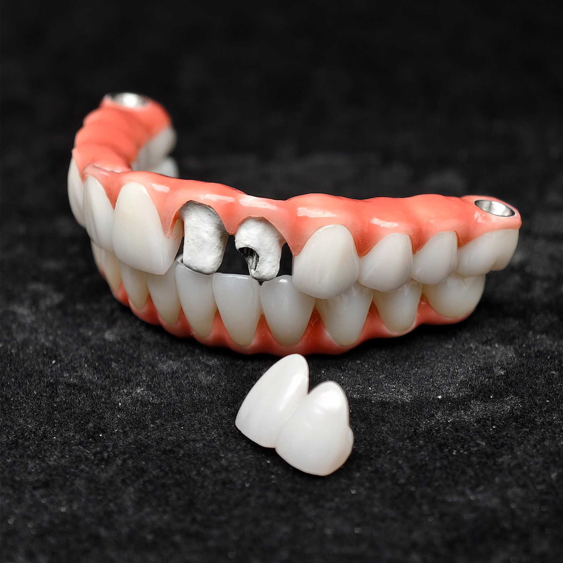 Zirconia-Enamel Hybrid Malo Bridge