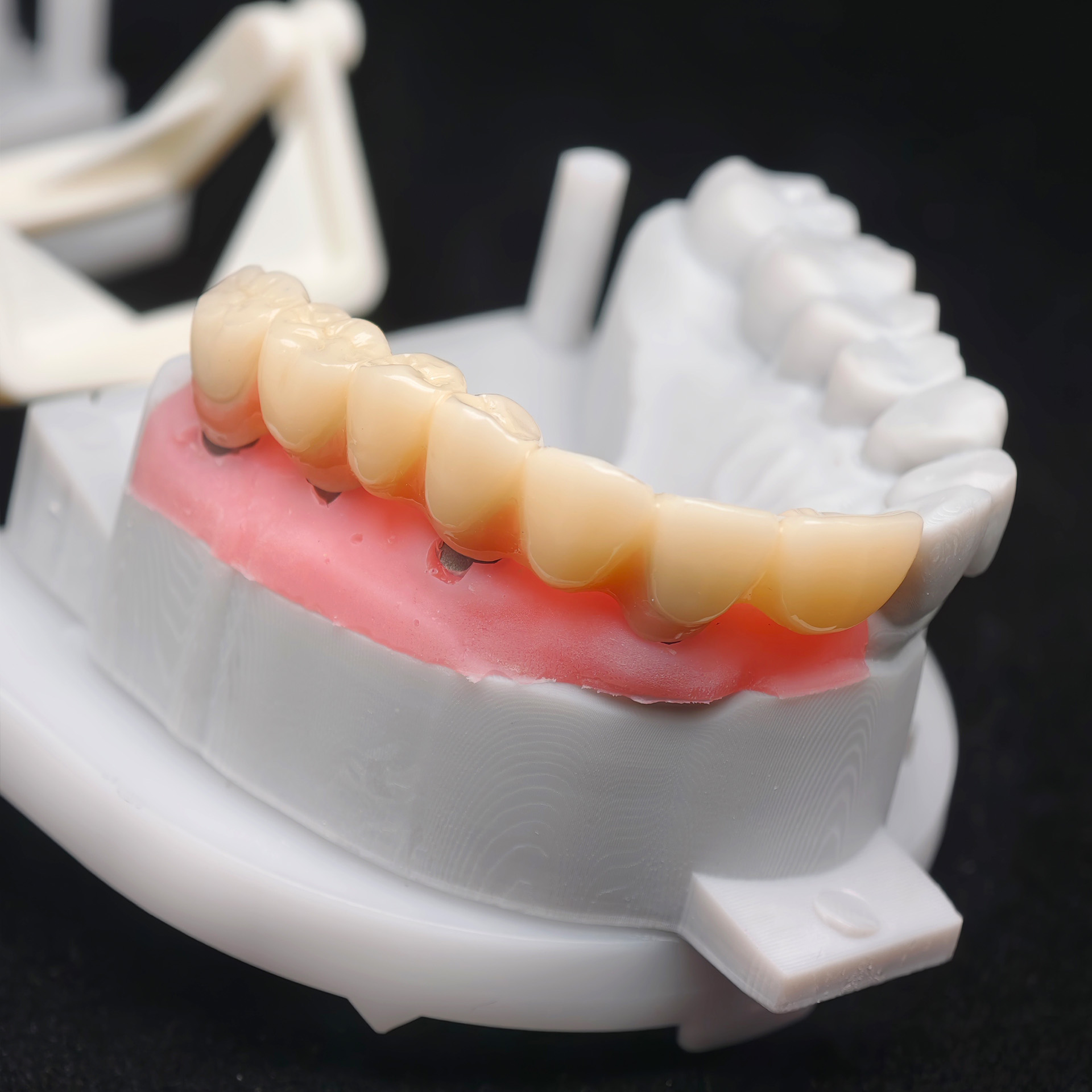 PMMA bridge with custom abutme