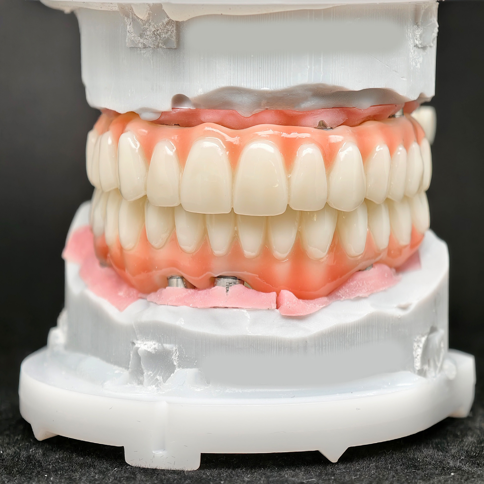 PMMA bridge with Ti-base screw retained 