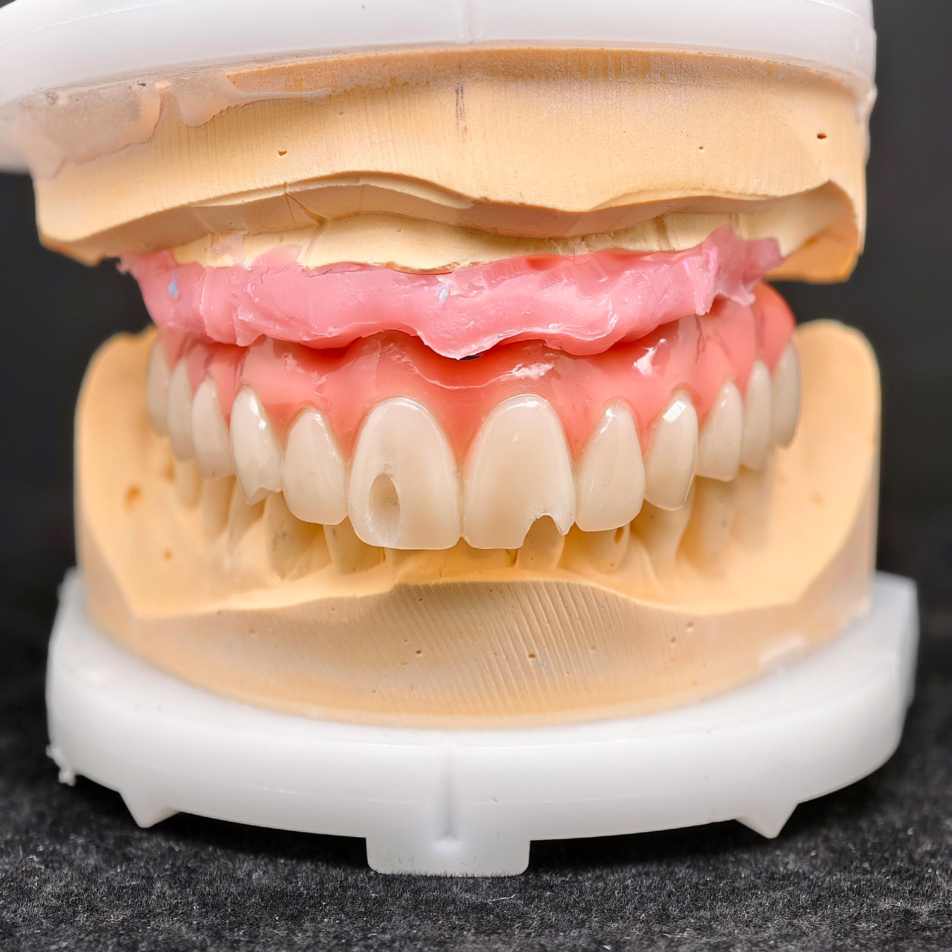 PMMA bridge with screw-retained