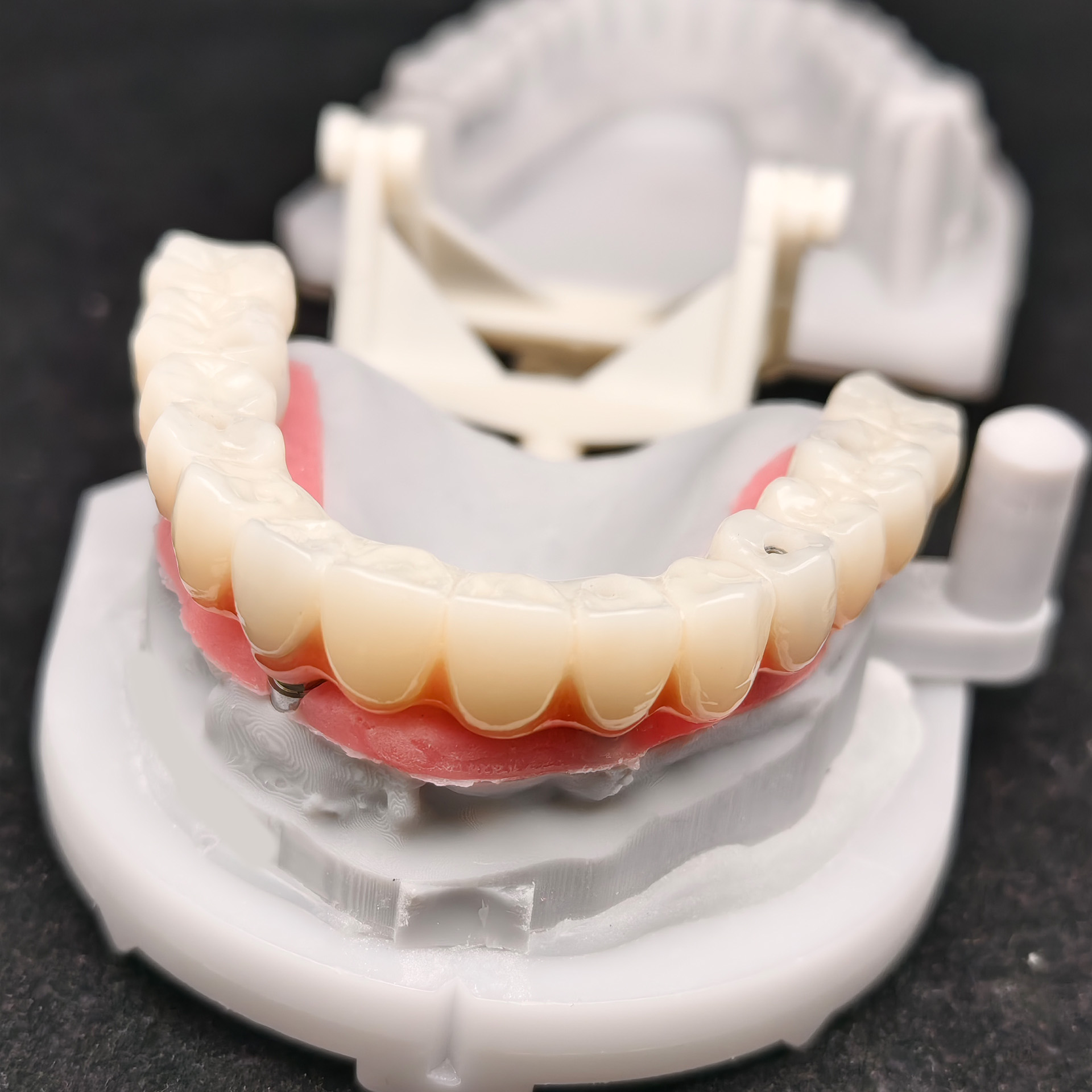 PMMA bridge with Ti-base screw