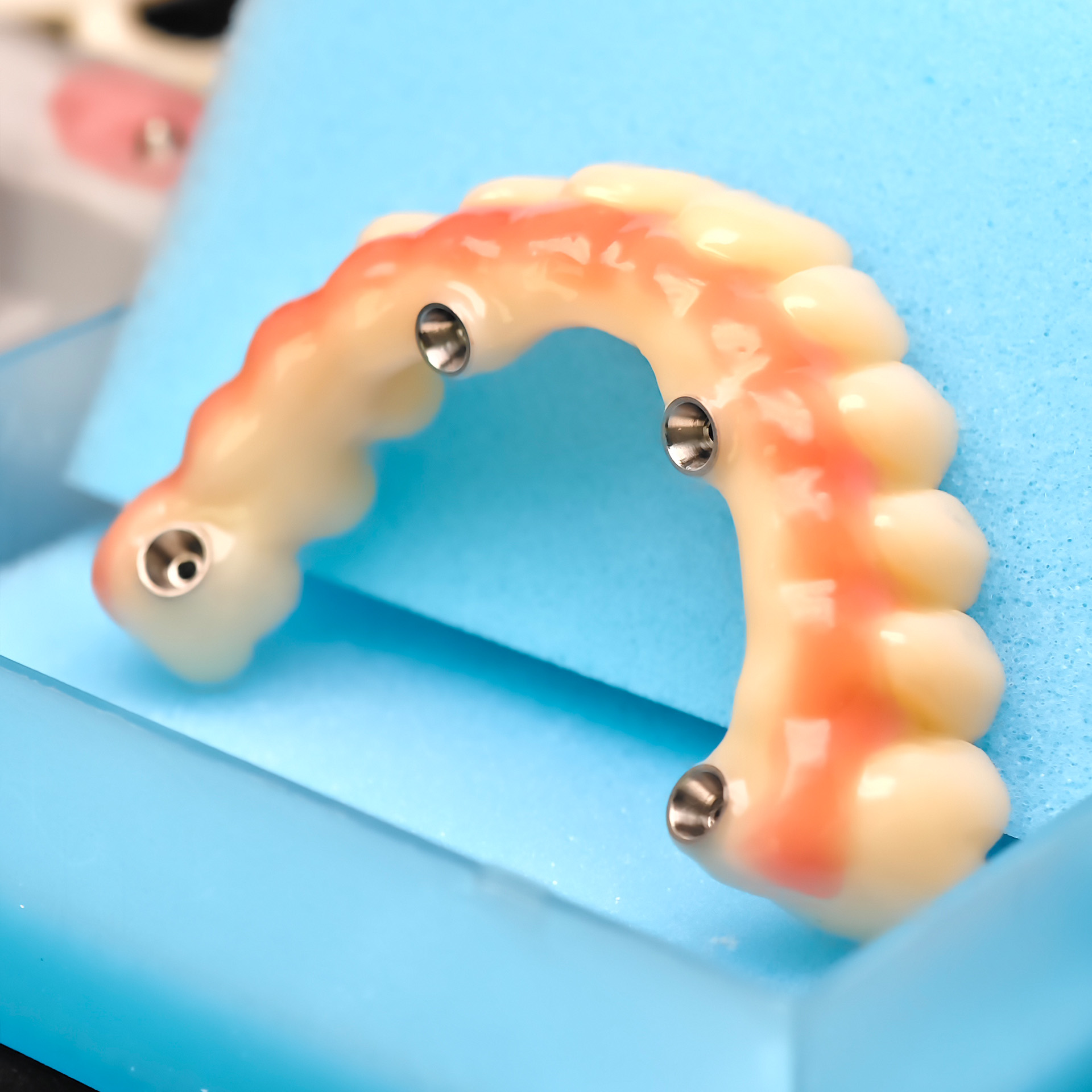 PMMA bridge with Ti-base screw retained 