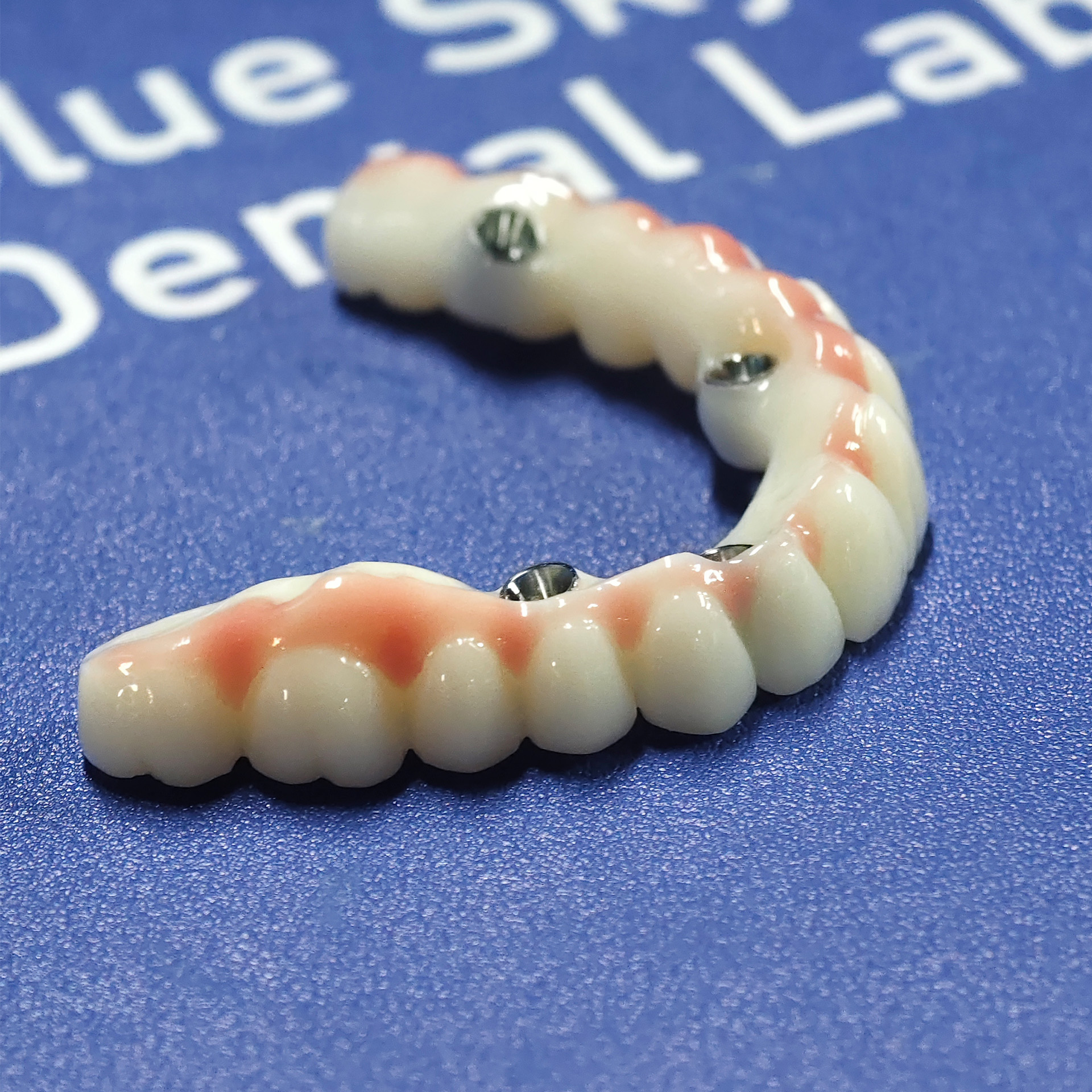 PMMA bridge with Ti-base screw retained 