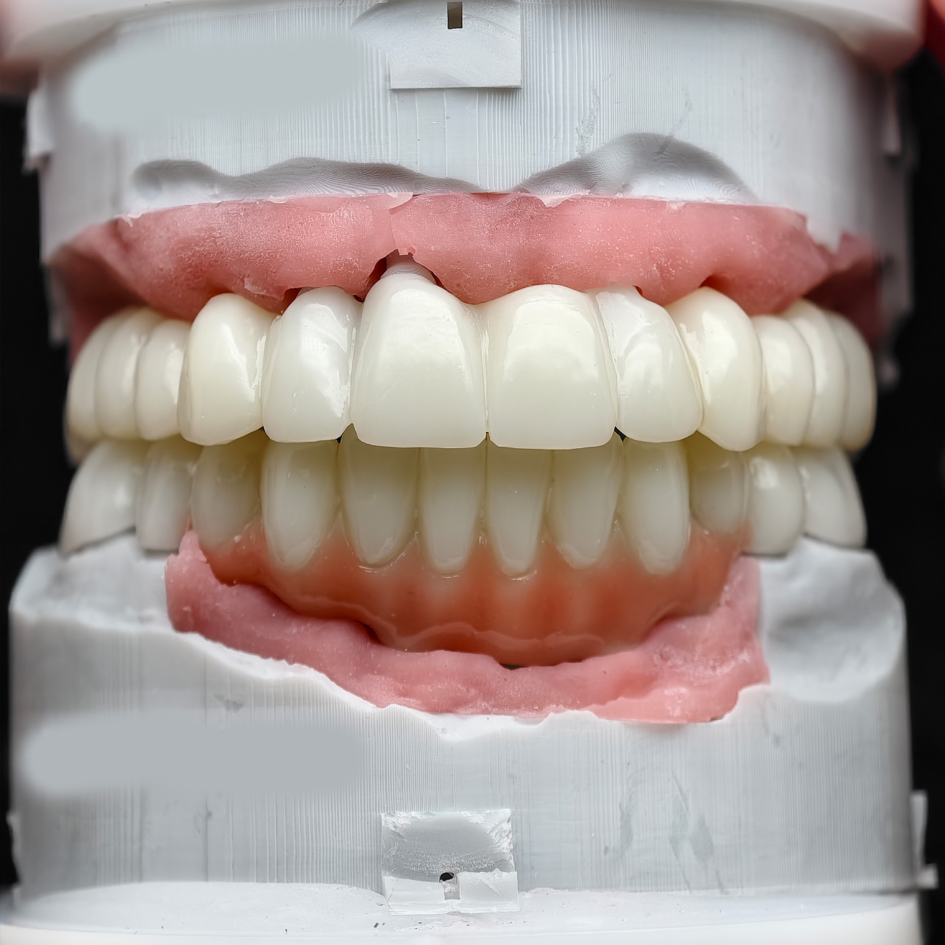 pmma bridge with implant seating guide a