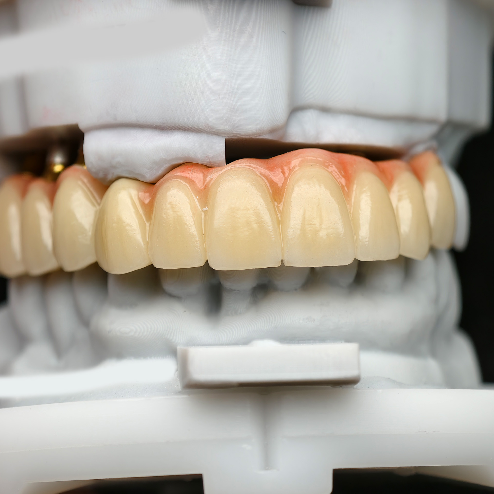 zirconia crown and birdge with cemented 