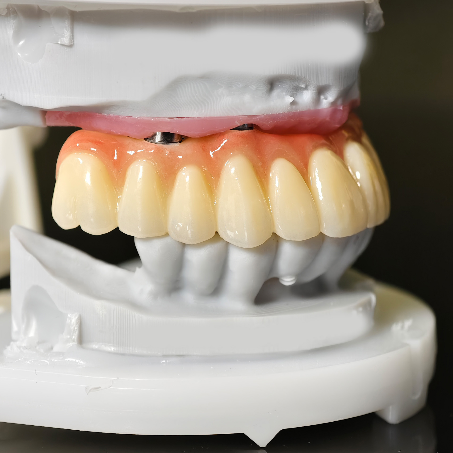 all on 5 zirconia bridge with Ti-base sc