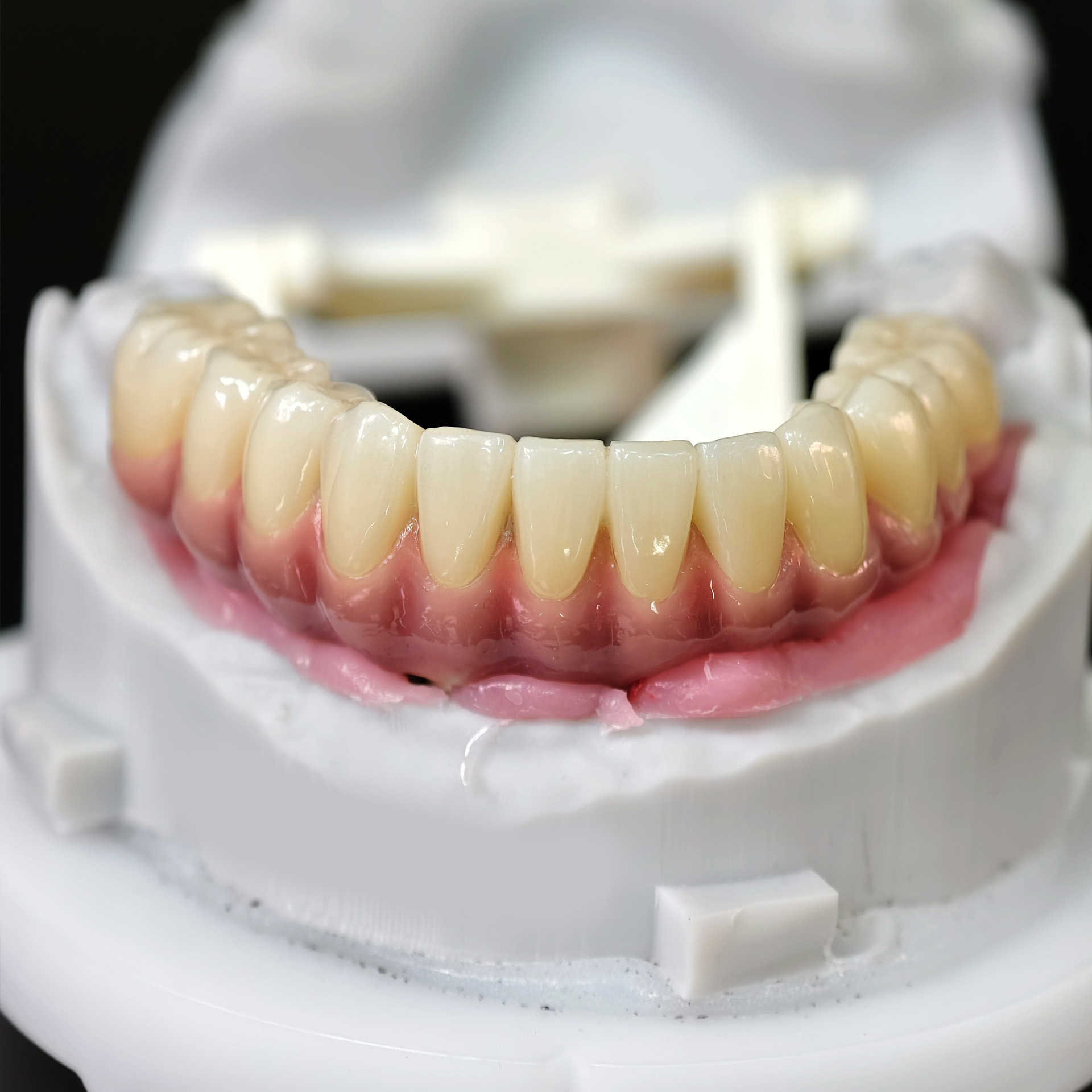 Enhanced Zirconia Crown Malo Bridge
