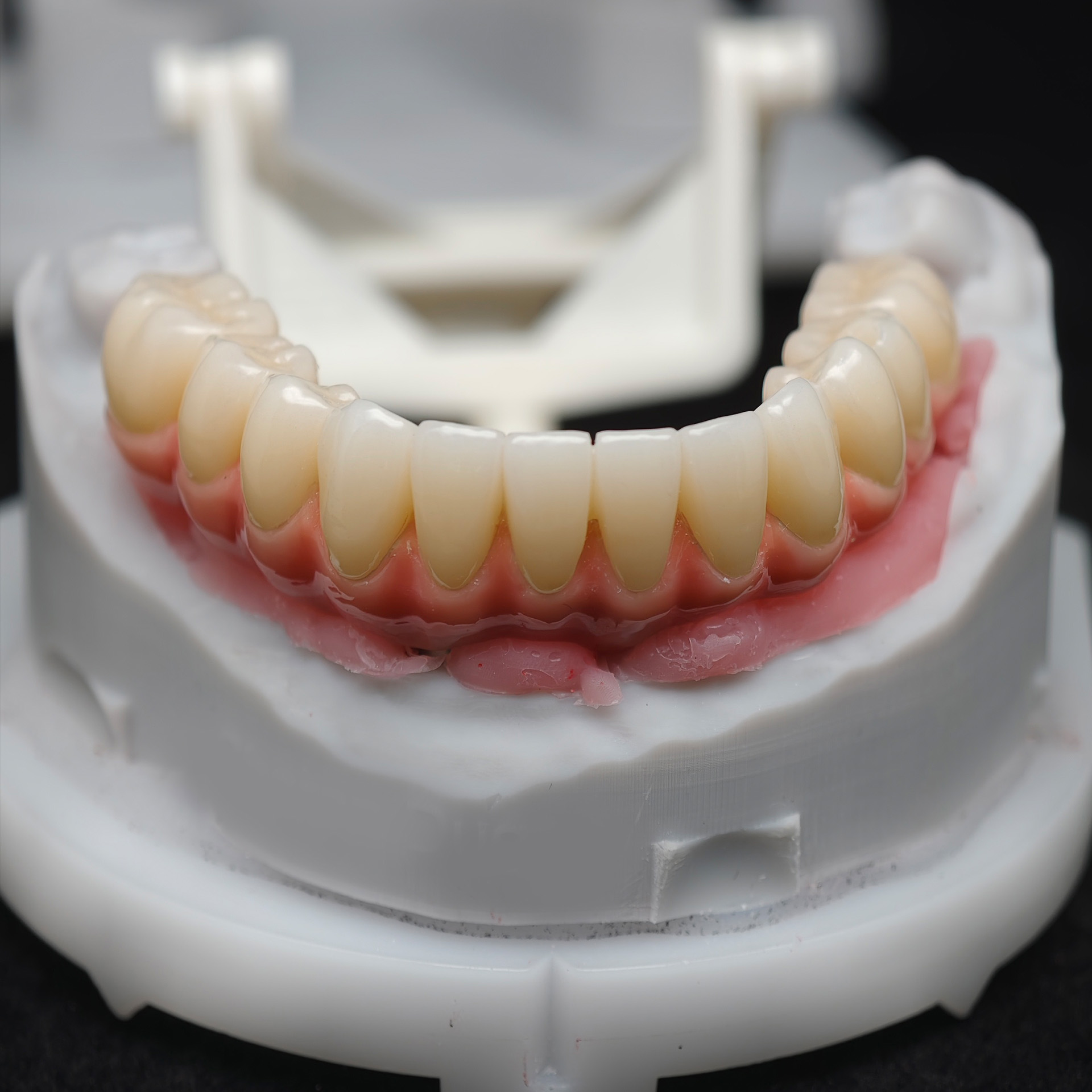 Enhanced Zirconia Crown Malo Bridge