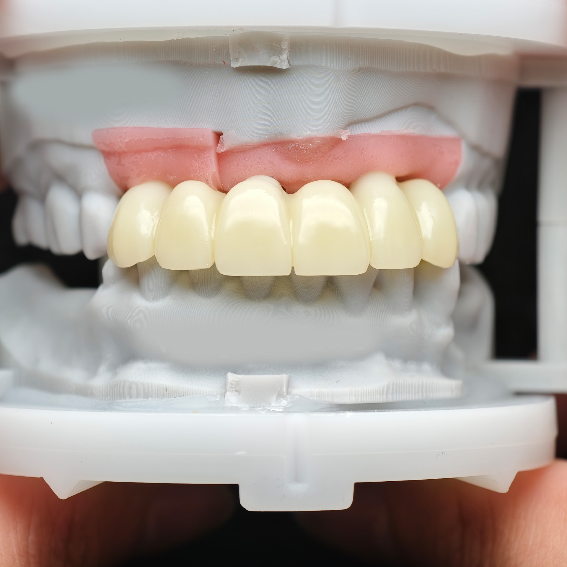 Pmma bridge with cement retained