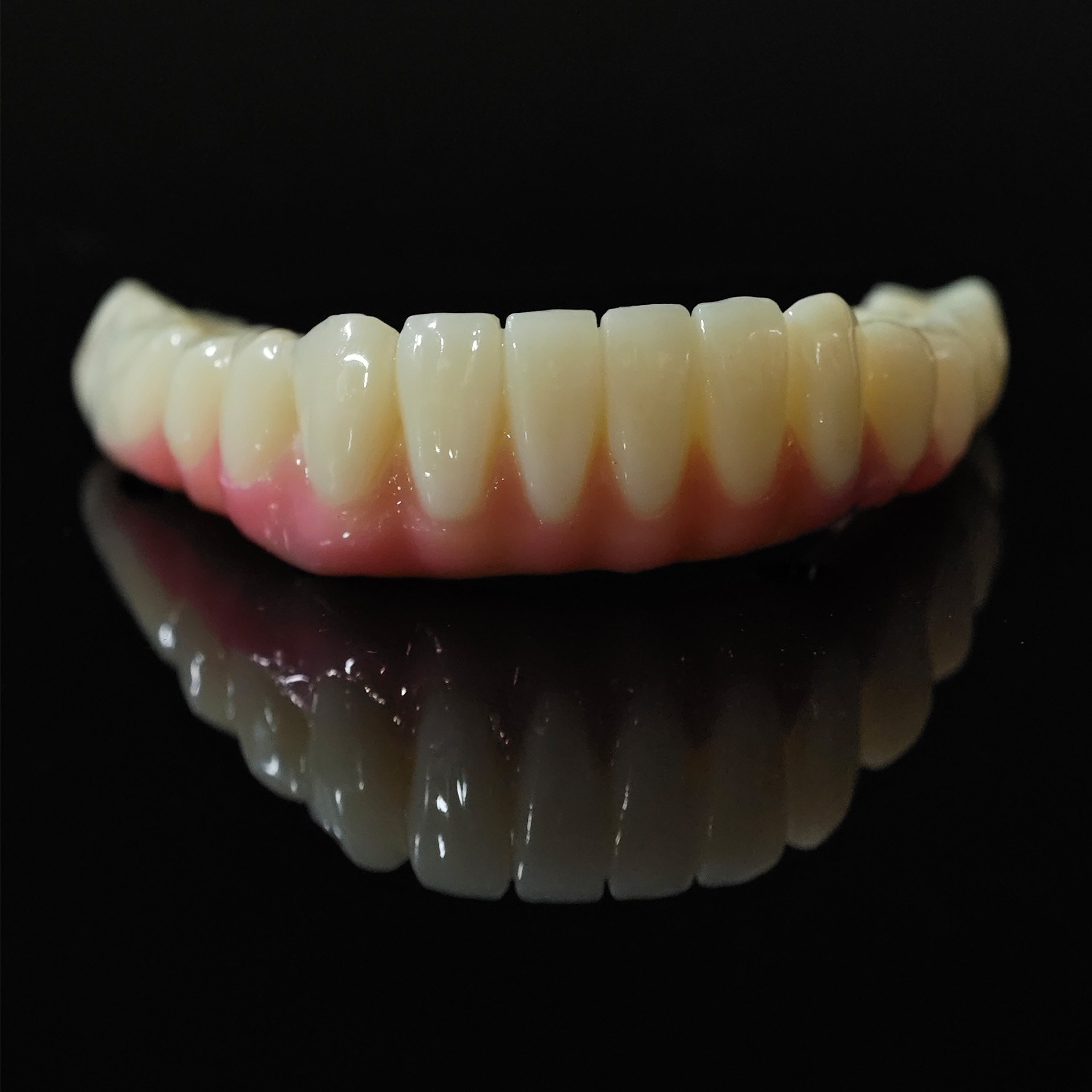 PMMA bridge with Ti-base screw retained 