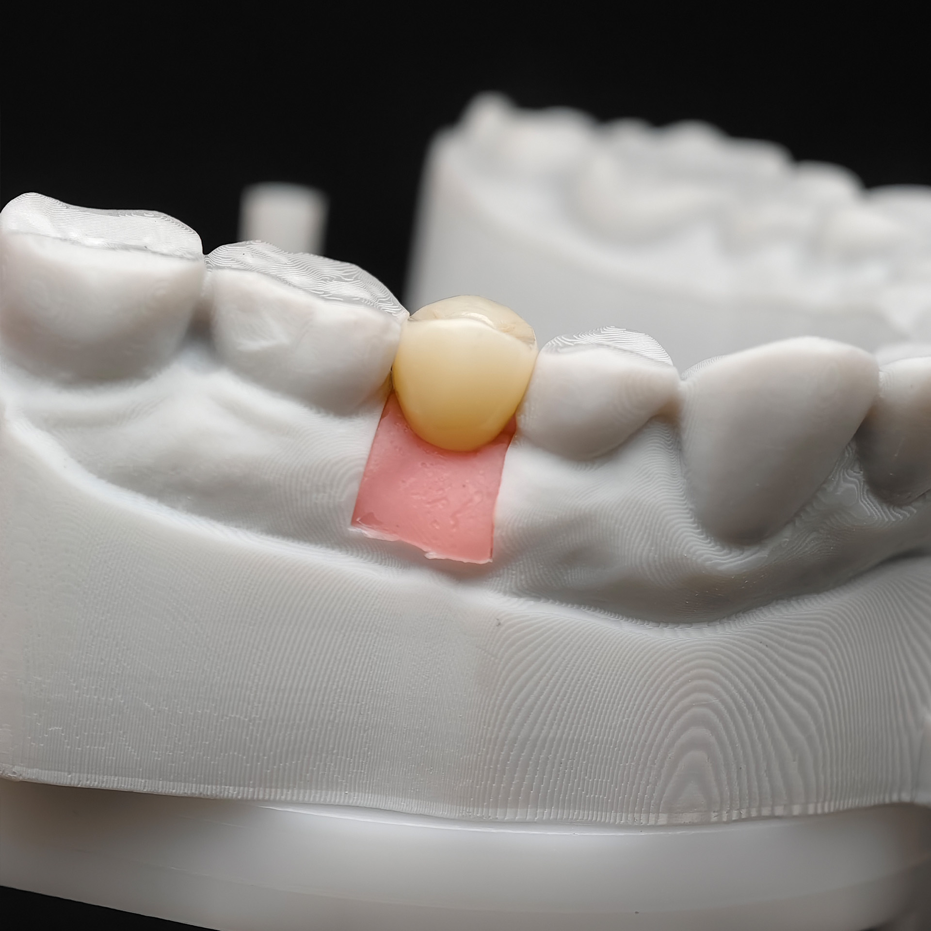 Custom Zirconia Implant Crowns