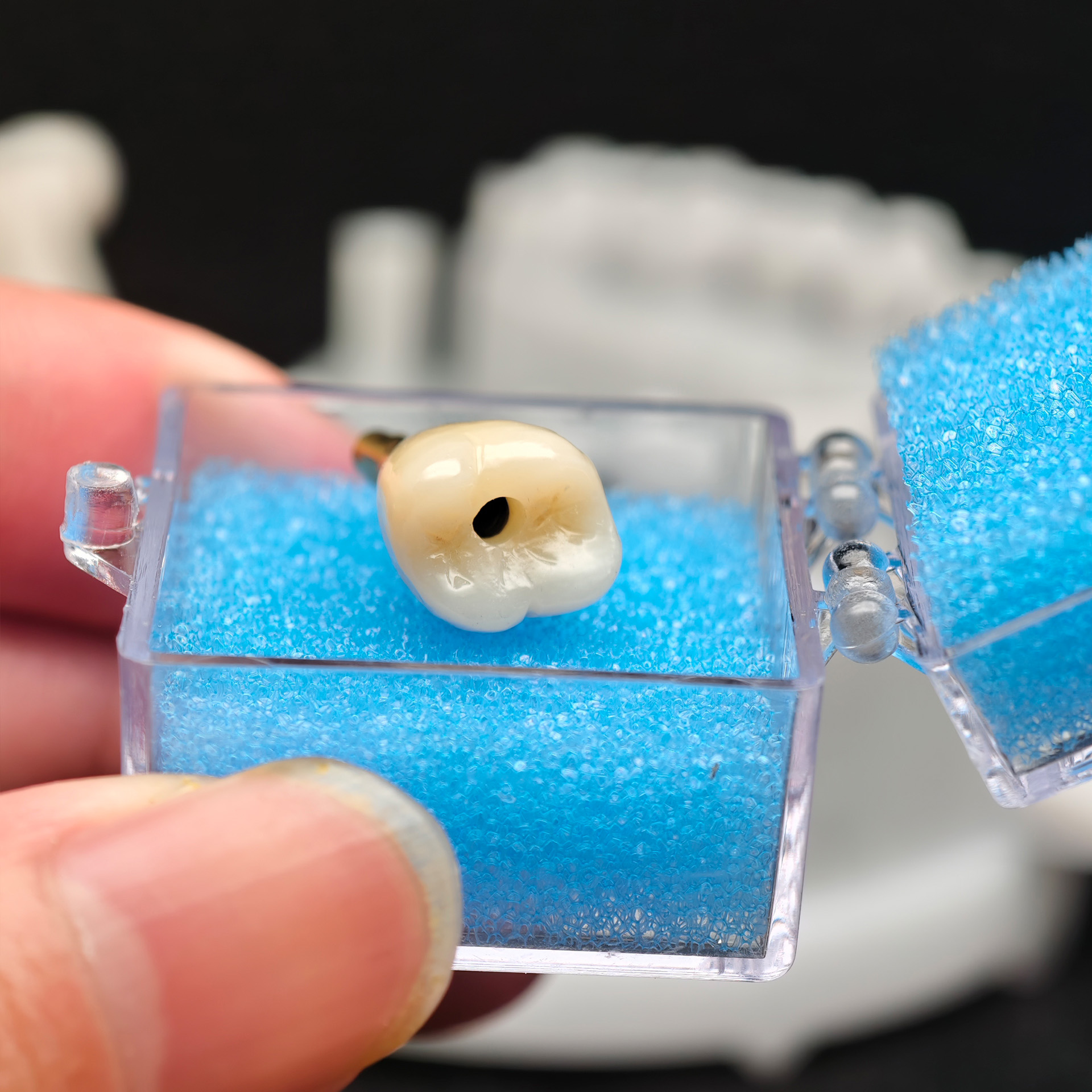 Zirconia crown with screw retained