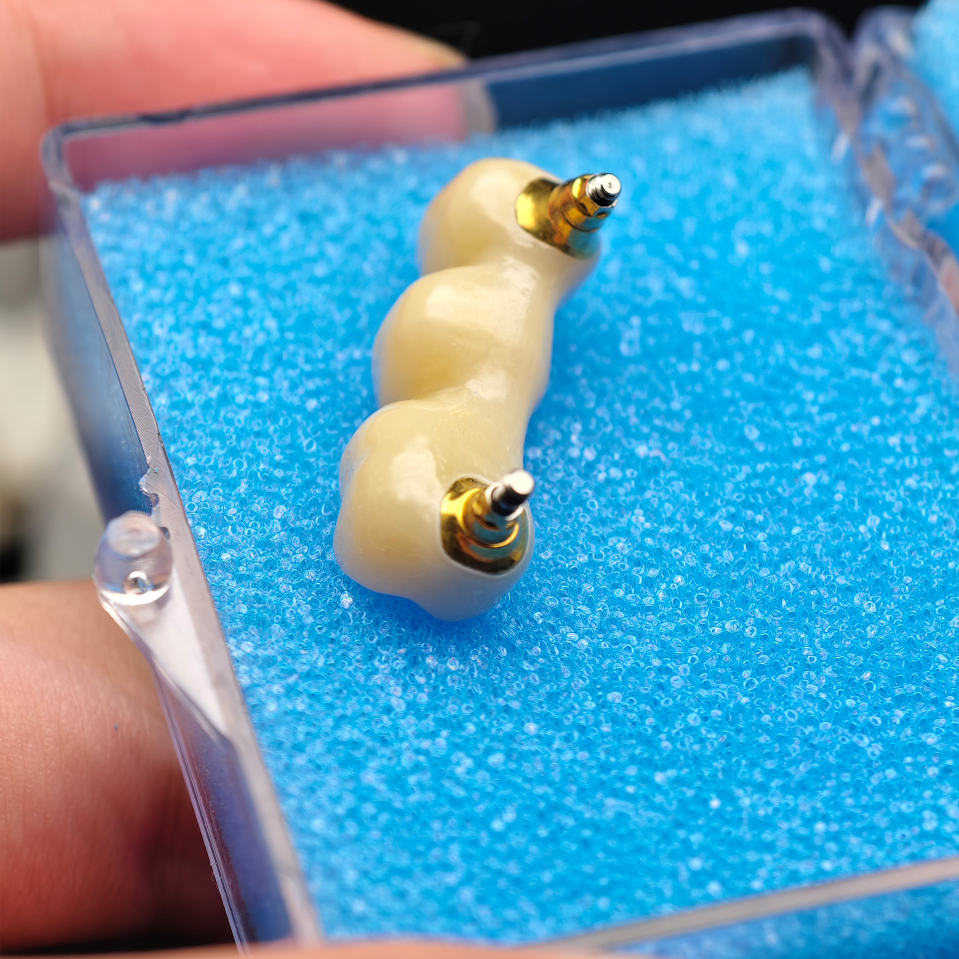 Custom Zirconia Implant Bridge