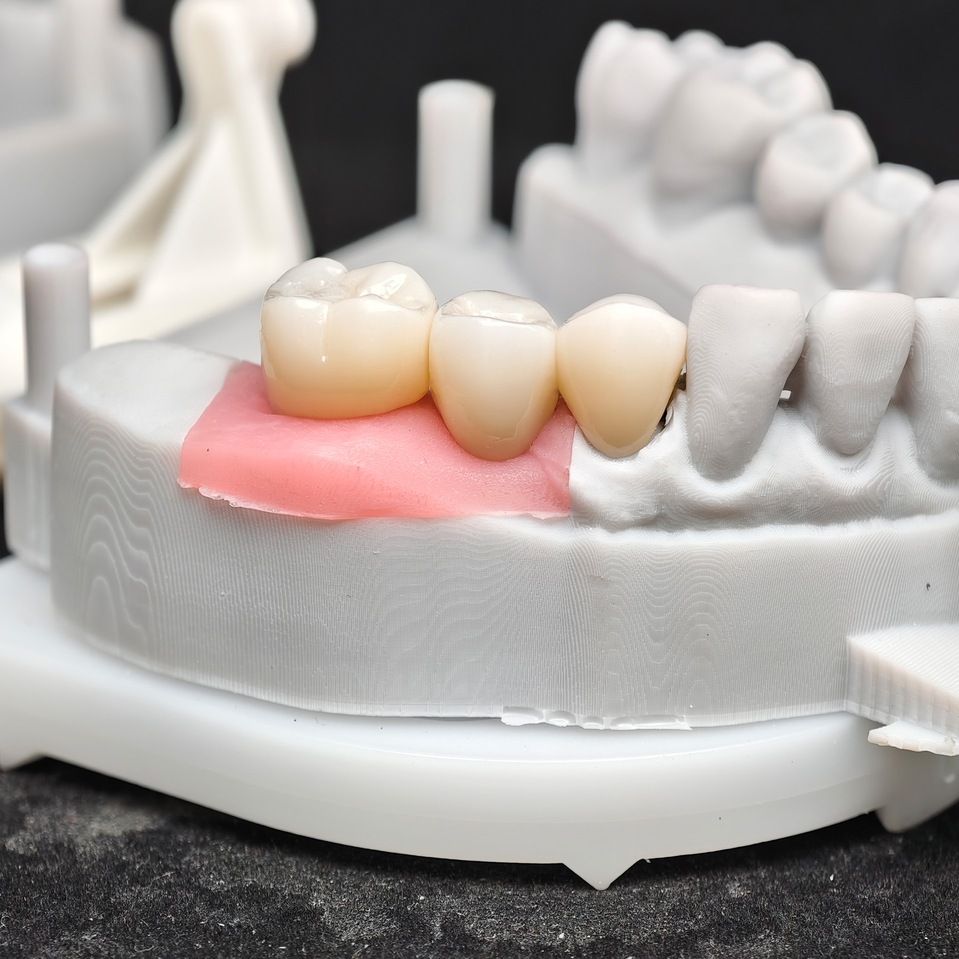 Zirconia crown and bridge with screw ret