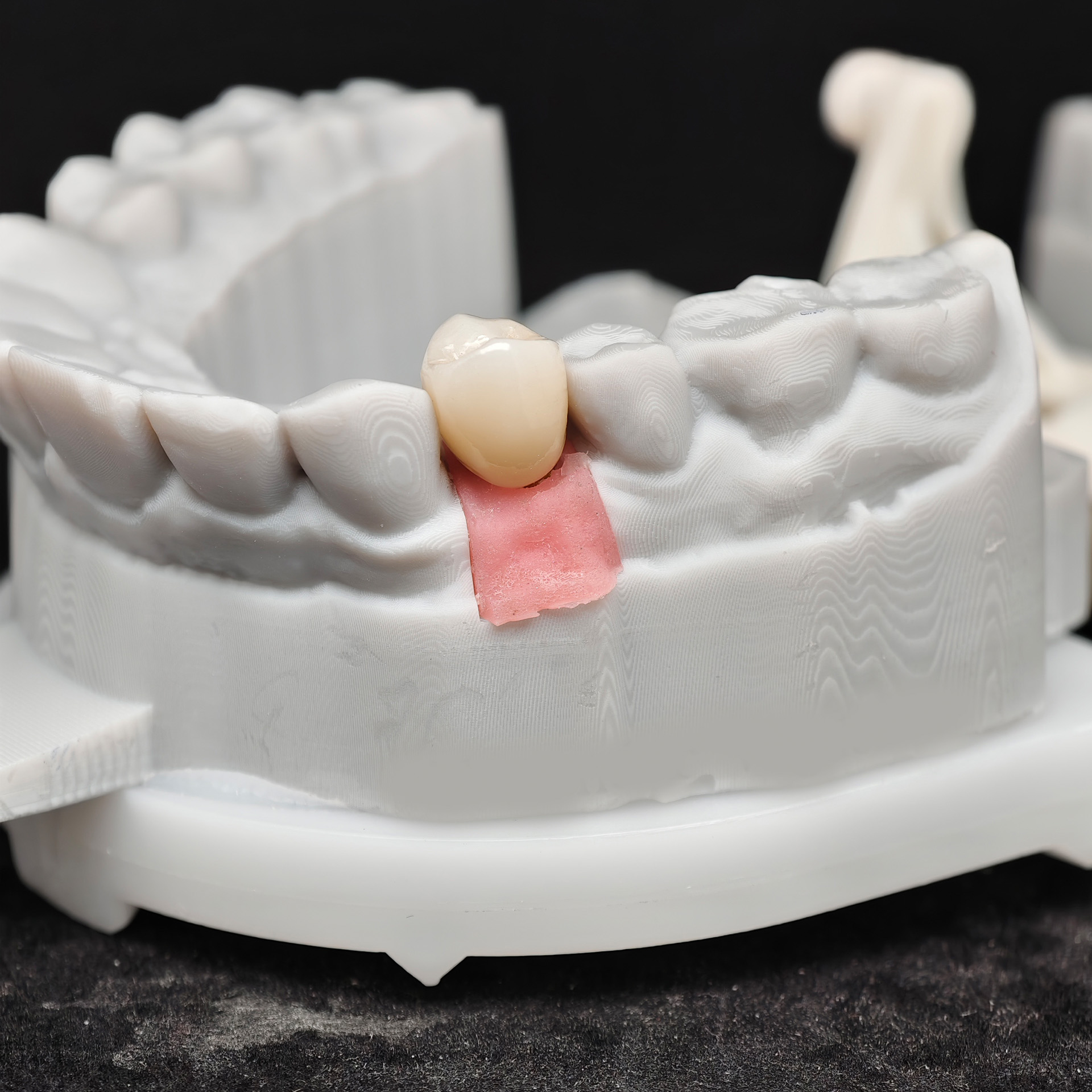 Zirconia implant crown Screwmentable den