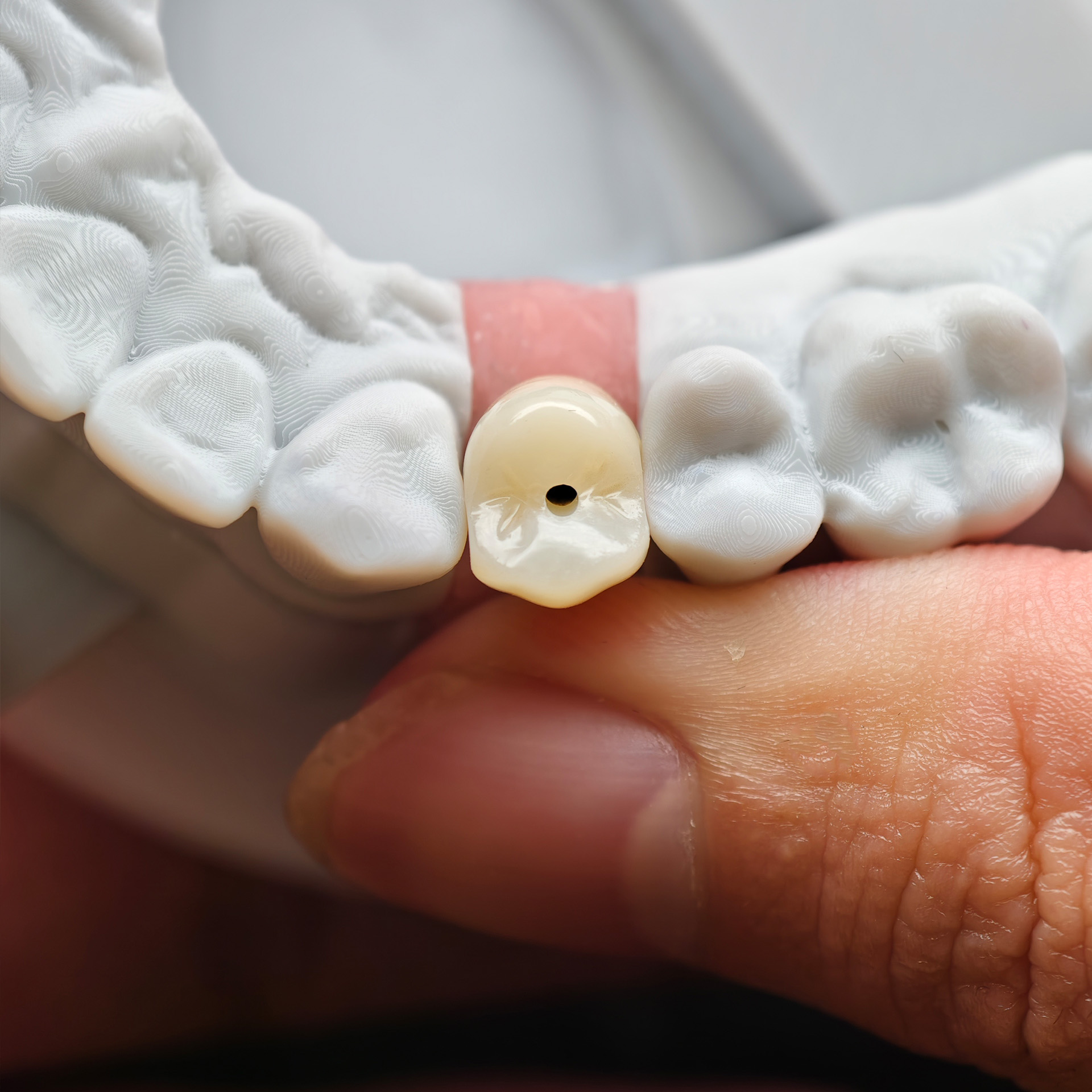 Zirconia implant crown Screwmentable den