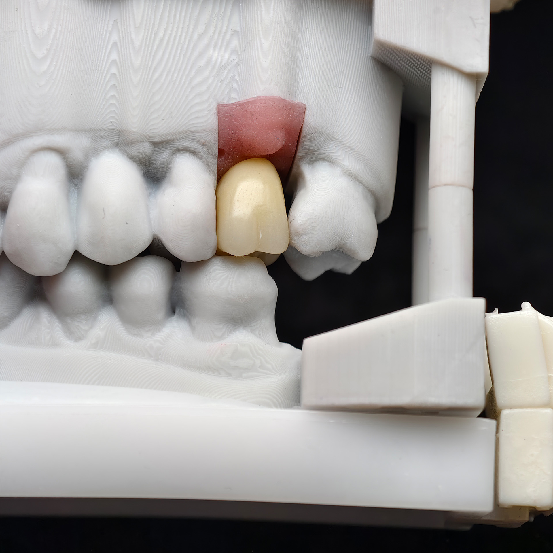 Zirconia crown with screw retained