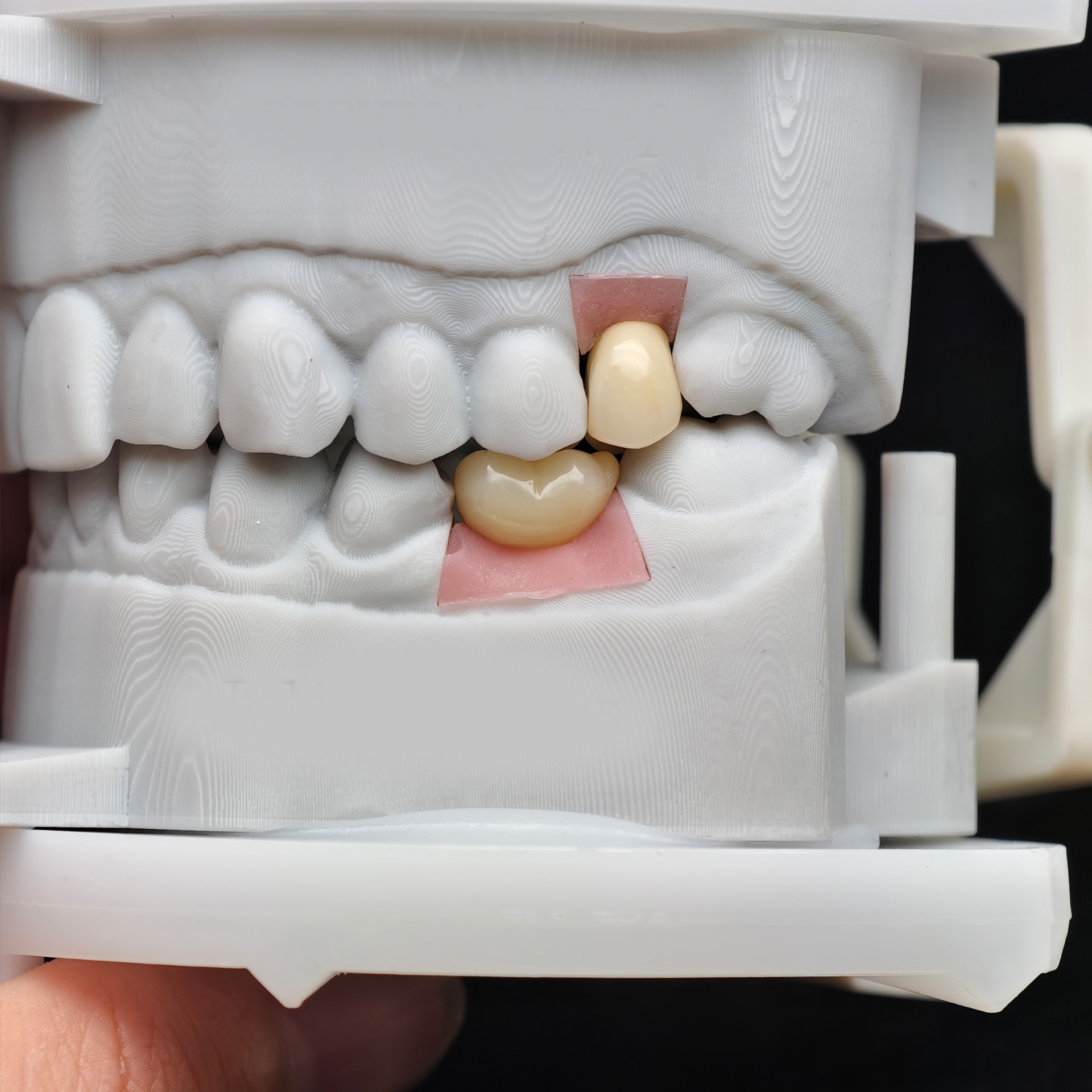 Custom Zirconia Implant Crowns