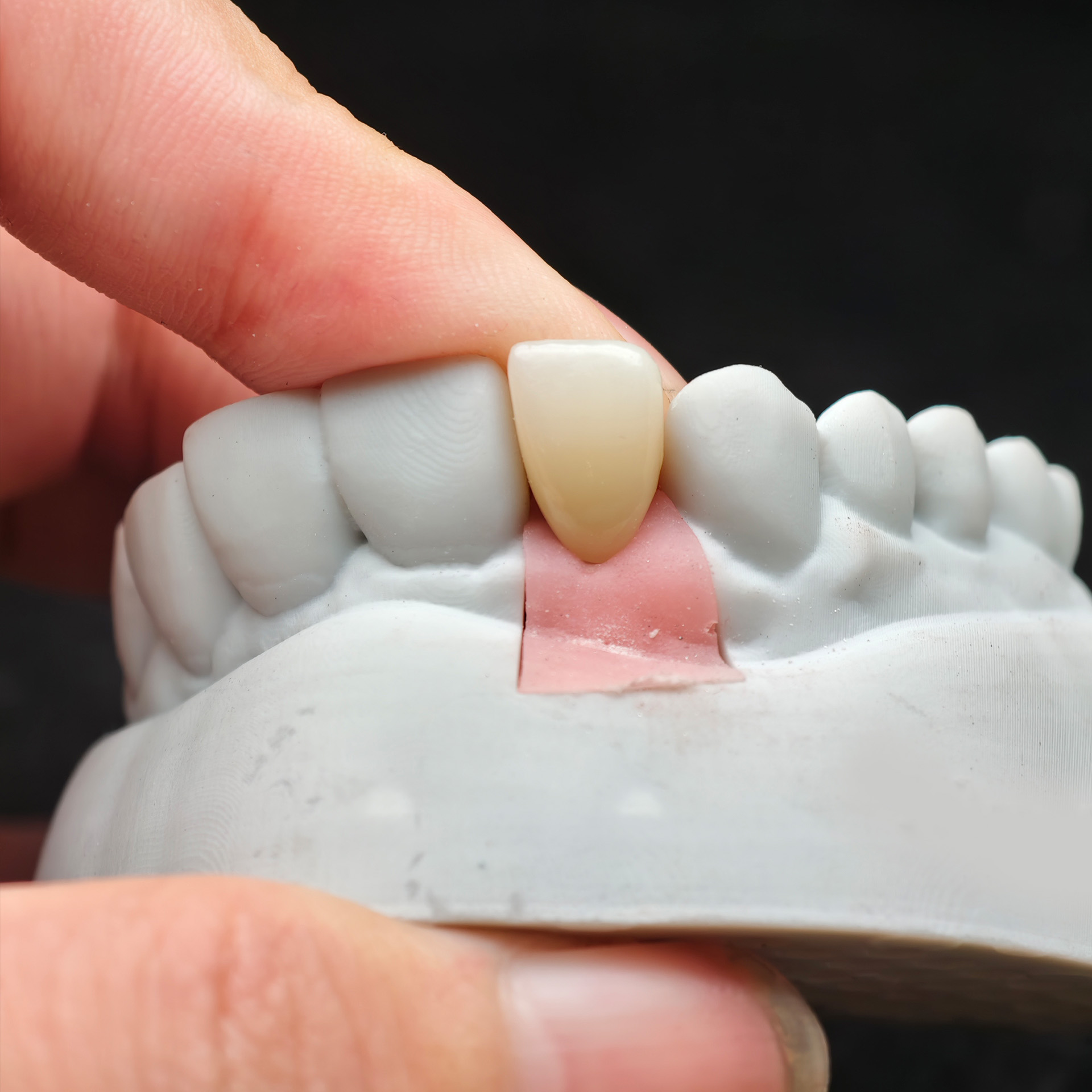 Zirconia implant crown Screwmentable den