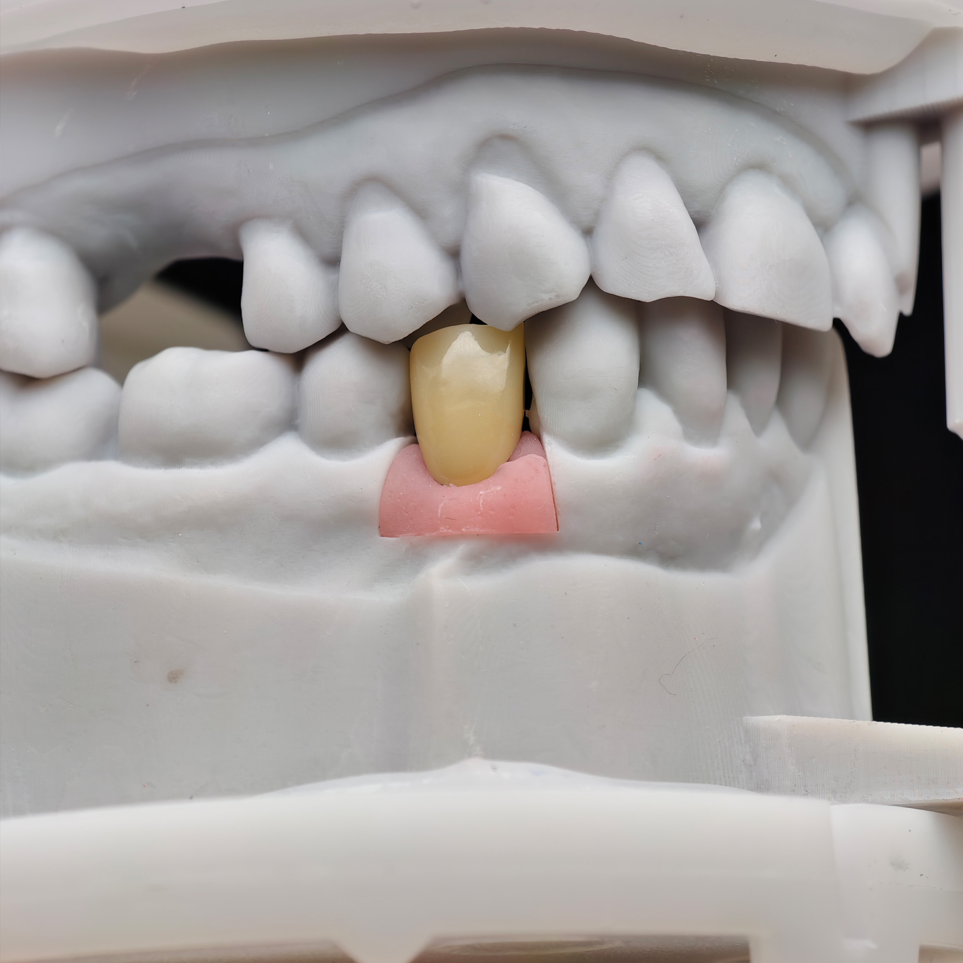 Zirconia crown with screw retained