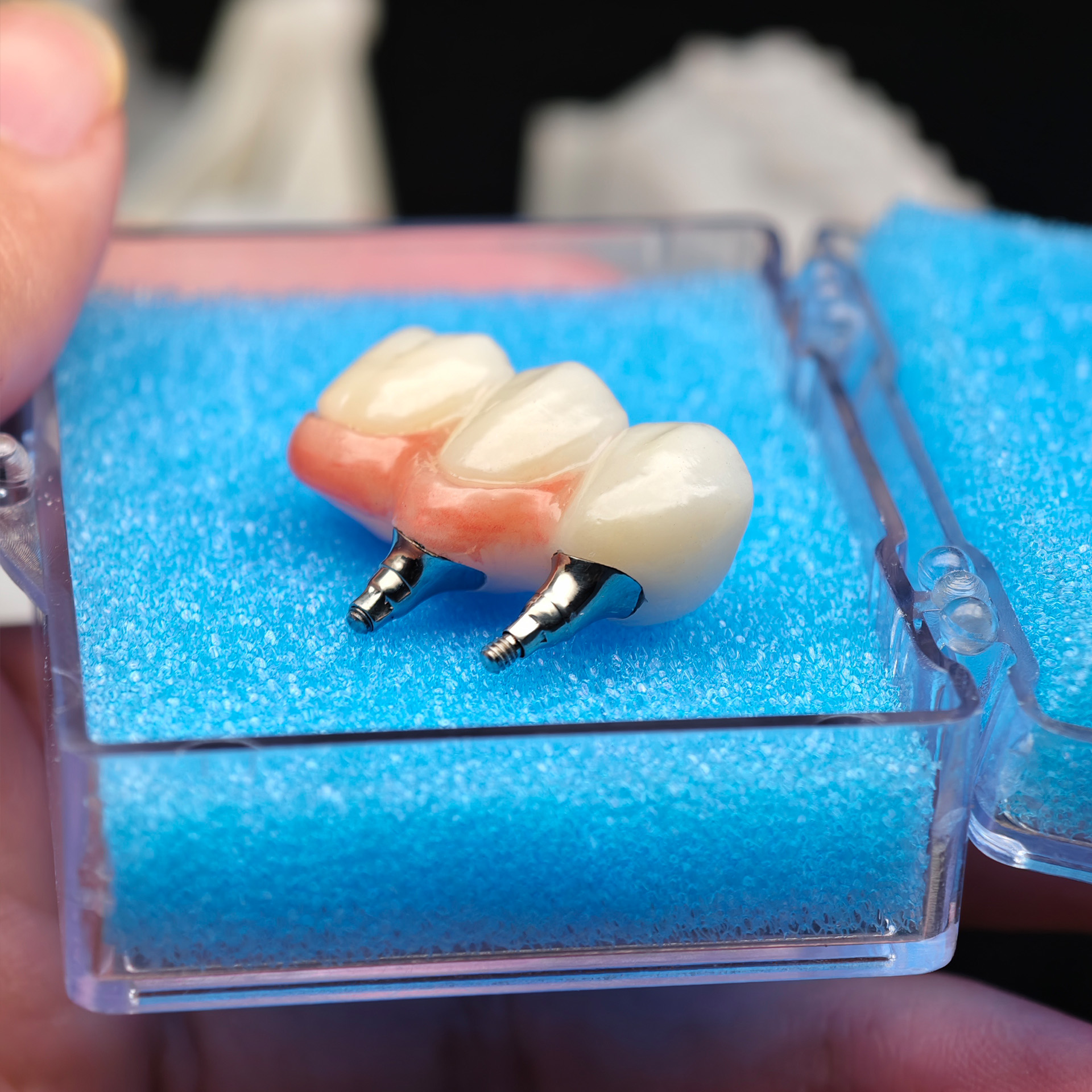 Zirconia bridge with screw retained