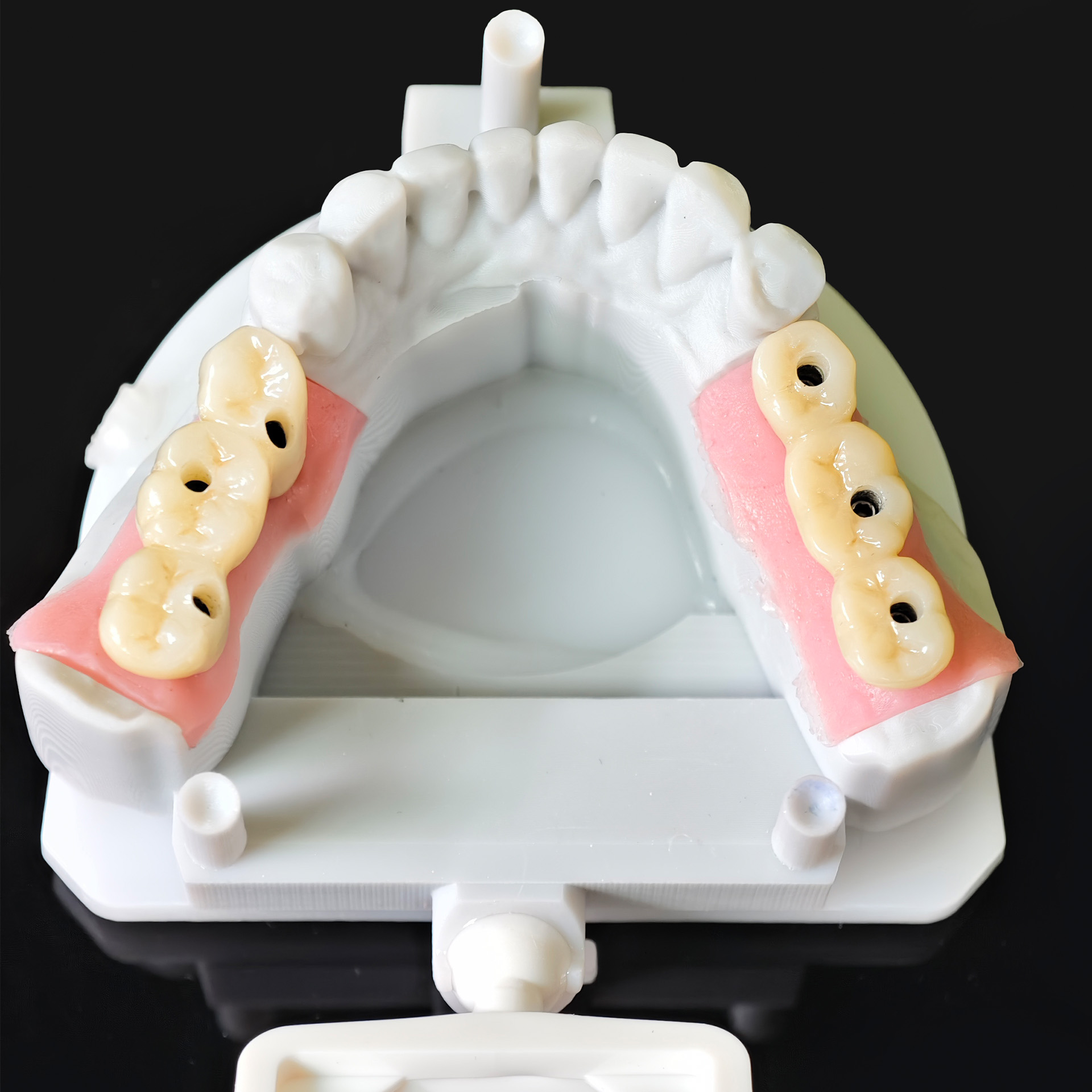 Zirconia bridge with screw retained  gol