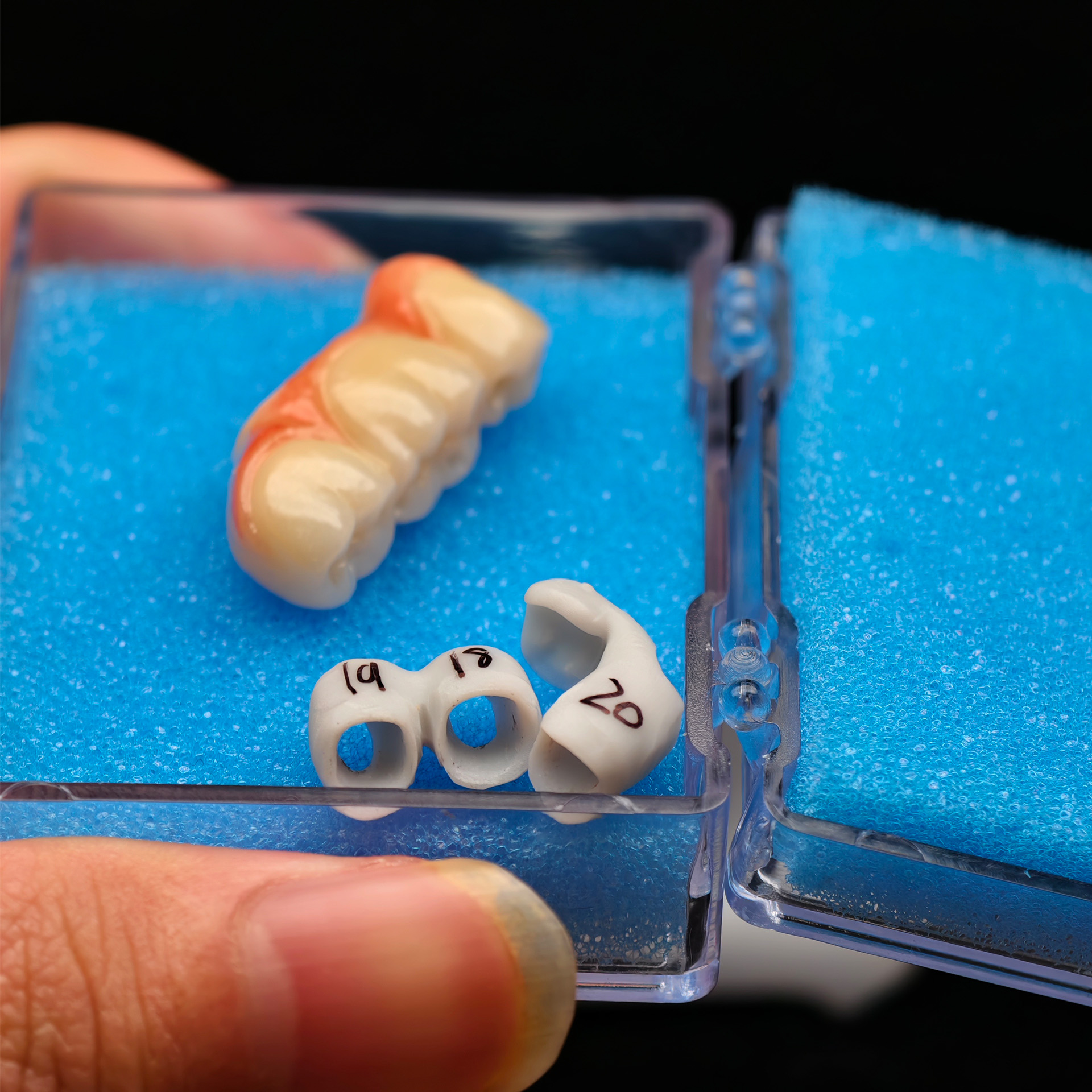 Zirconia implant crown Screwmentable den