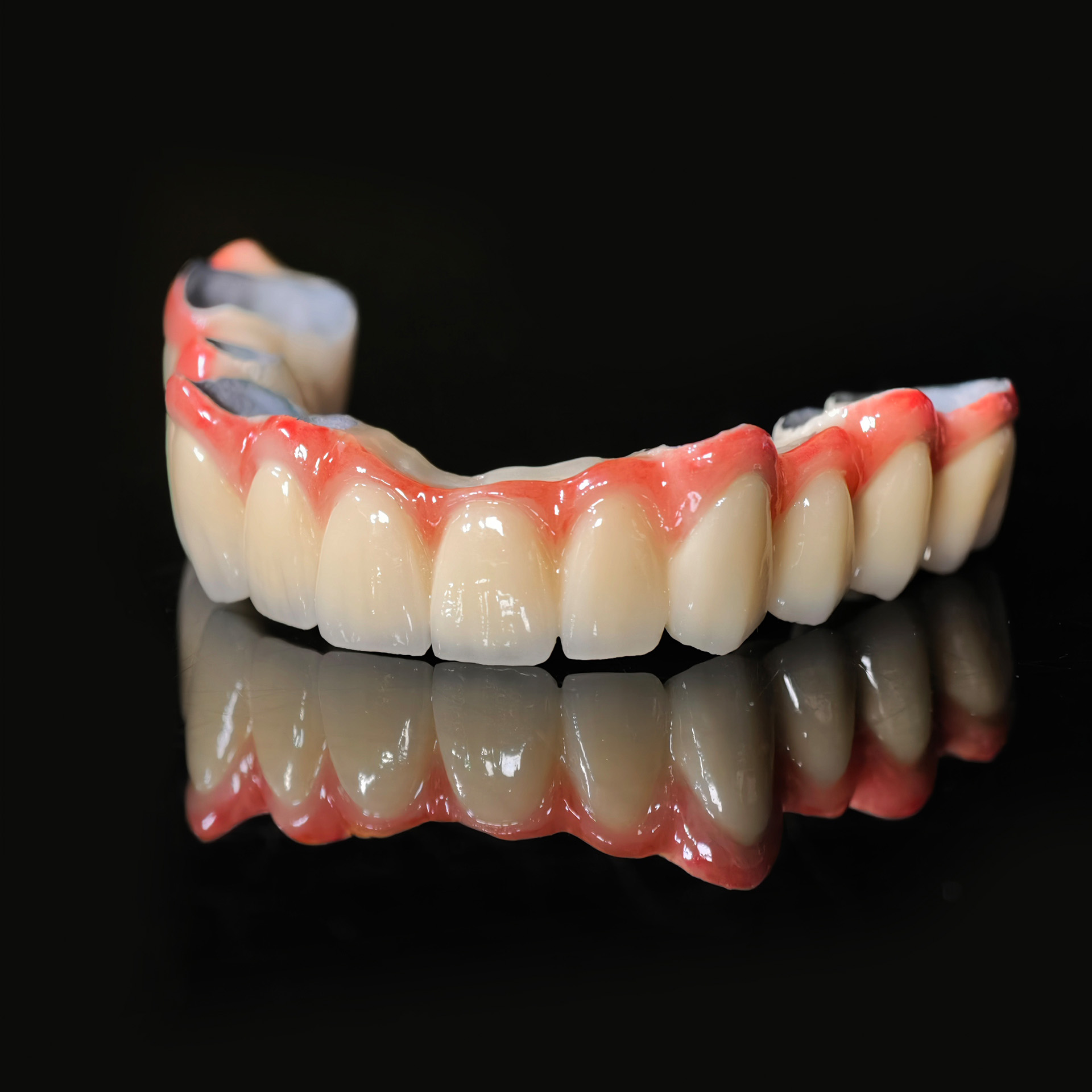 PFM bridge with cement retained