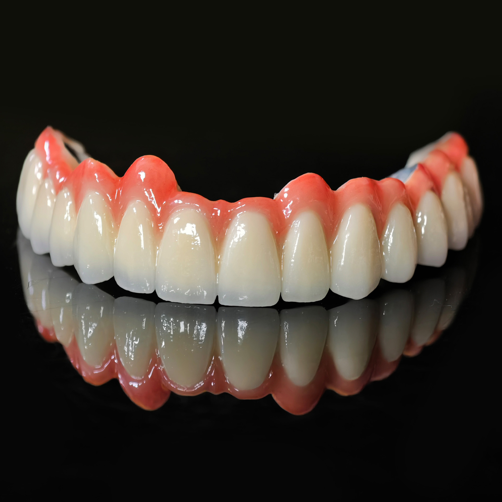 PFM bridge with cement retained