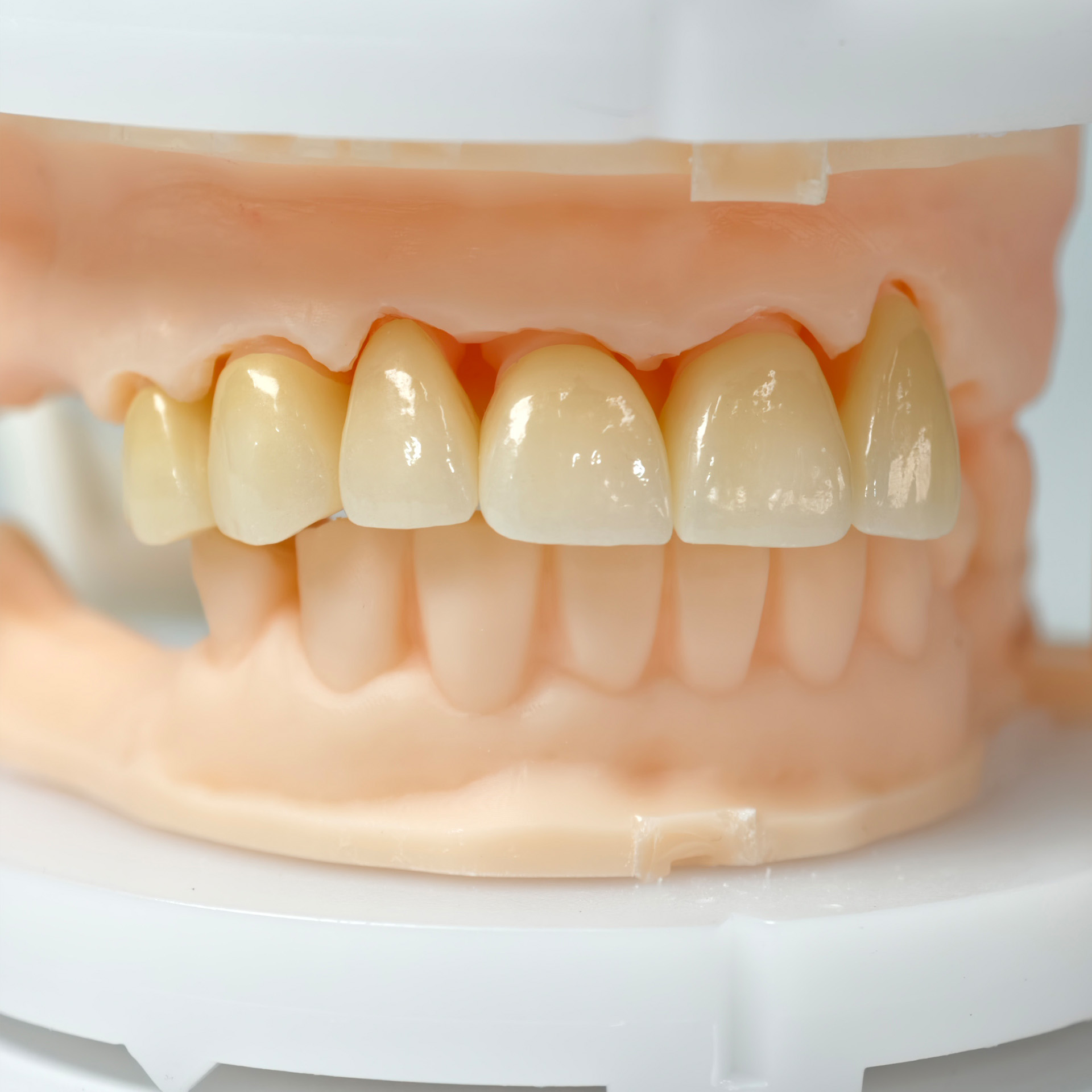 High - Strength Zirconia Crowns