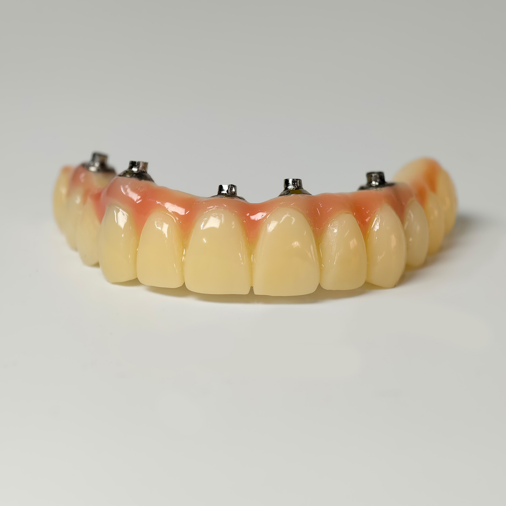 PMMA bridge with screw retained