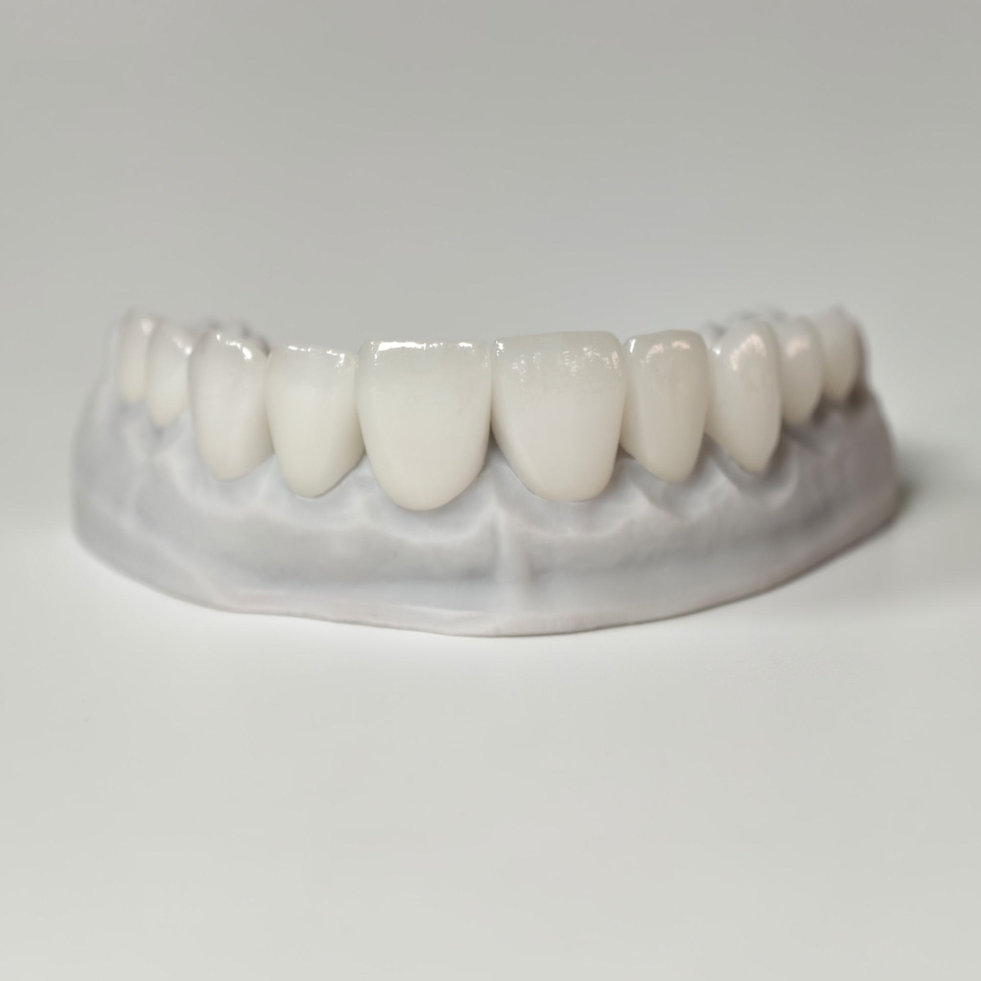 Ultra-thin emax veneer. High transparenc